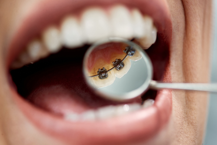 Lingual Orthodontics: Braces Inside Teeth 