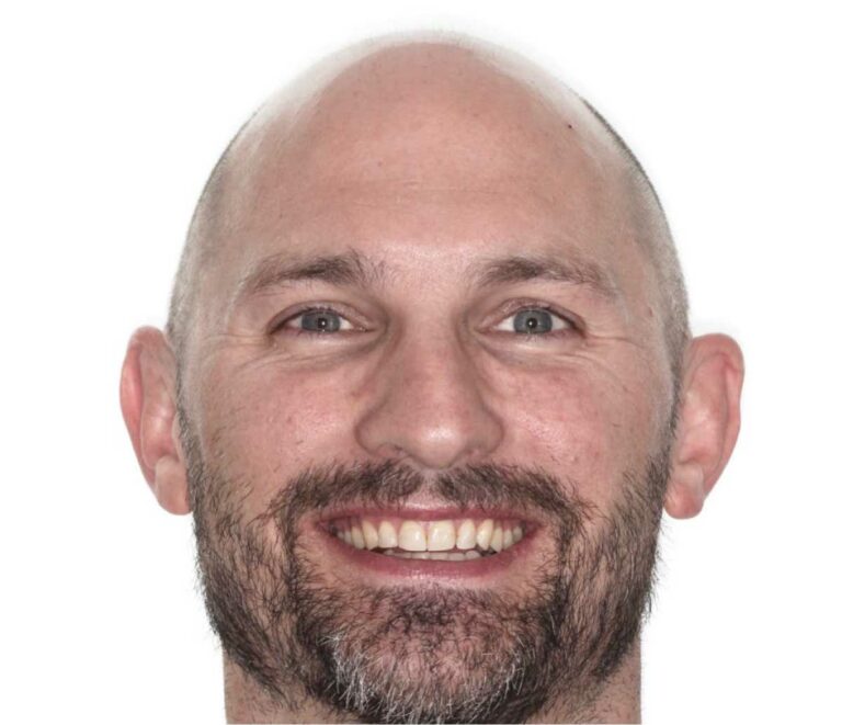 The same adult patient's smile after orthodontic treatment at aligned. Orthodontics in Denver