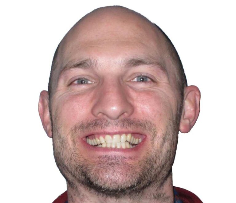 Adult patient's smile before orthodontic treatment at aligned. Orthodontics in Denver
