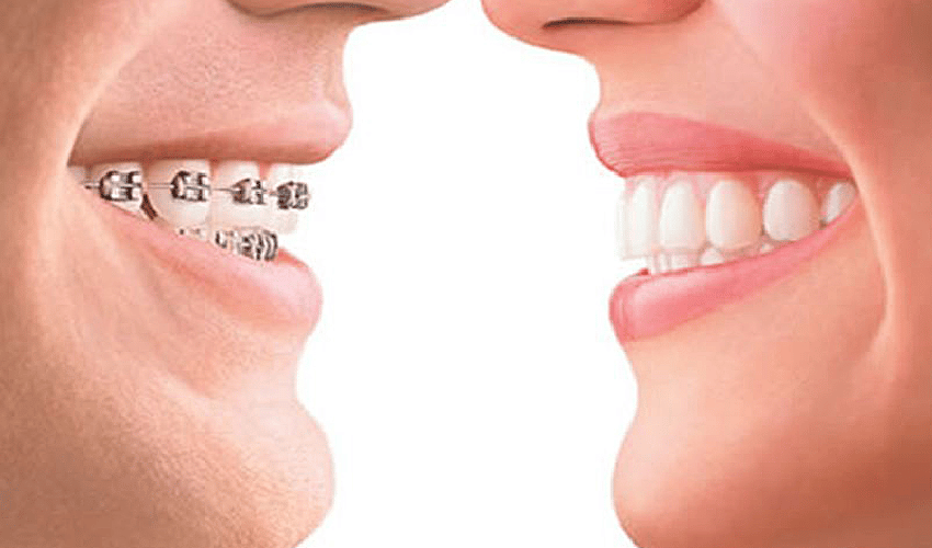 Clear Aligners vs Braces: Which is Best for You?