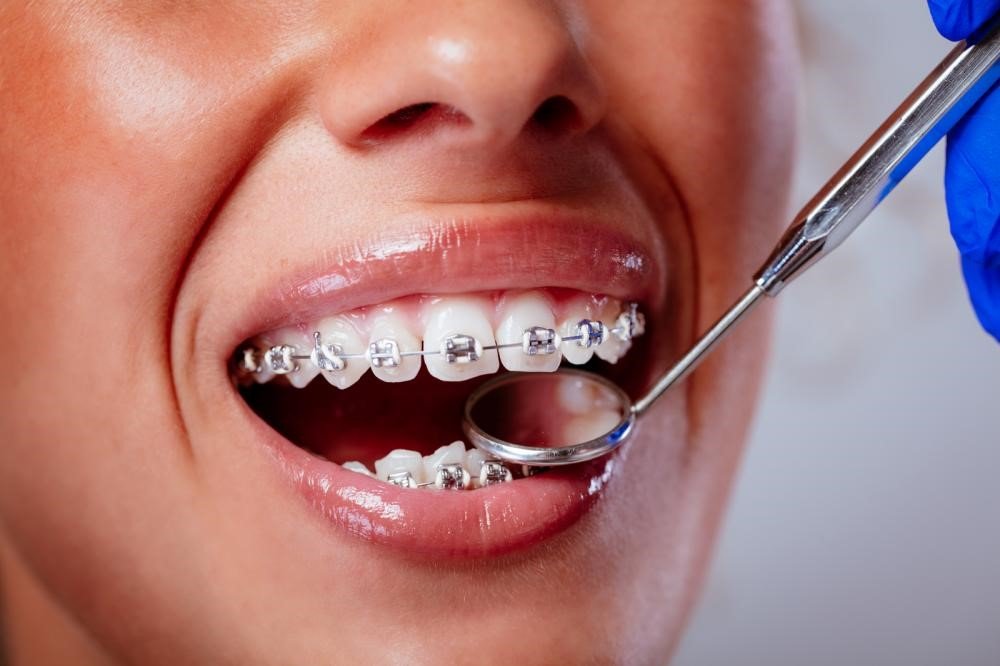 How Much Does Orthodontic Treatment Cost? | 2025 Guide