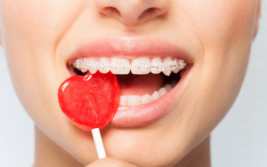 Foods to Avoid with Braces – Complete Guide 2025