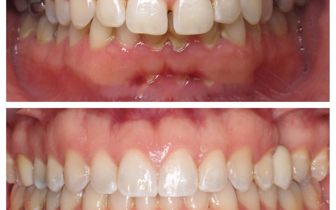 Invisalign in South Denver: Aligned Orthodontics on South Pearl Street