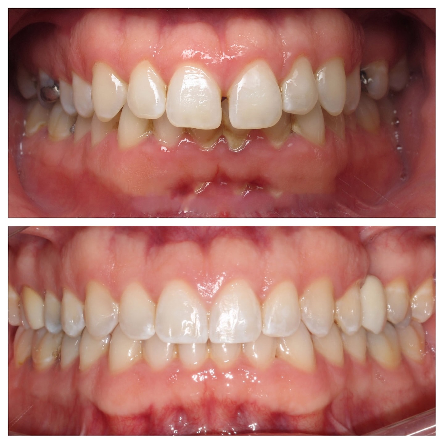 Invisalign before and after results in South Denver showing closed front tooth gap and aligned bite, treated by Dr. Vanderstelt at Aligned Orthodontics