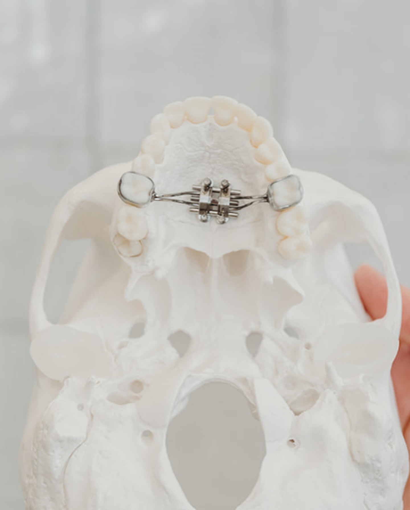 A traditional rapid palatal expander (RPE) shown on a skull model at Aligned Orthodontics, an airway orthodontist in Denver. Metal bands cement to the upper back molars on each side, connected to a central screw that widens the palate.