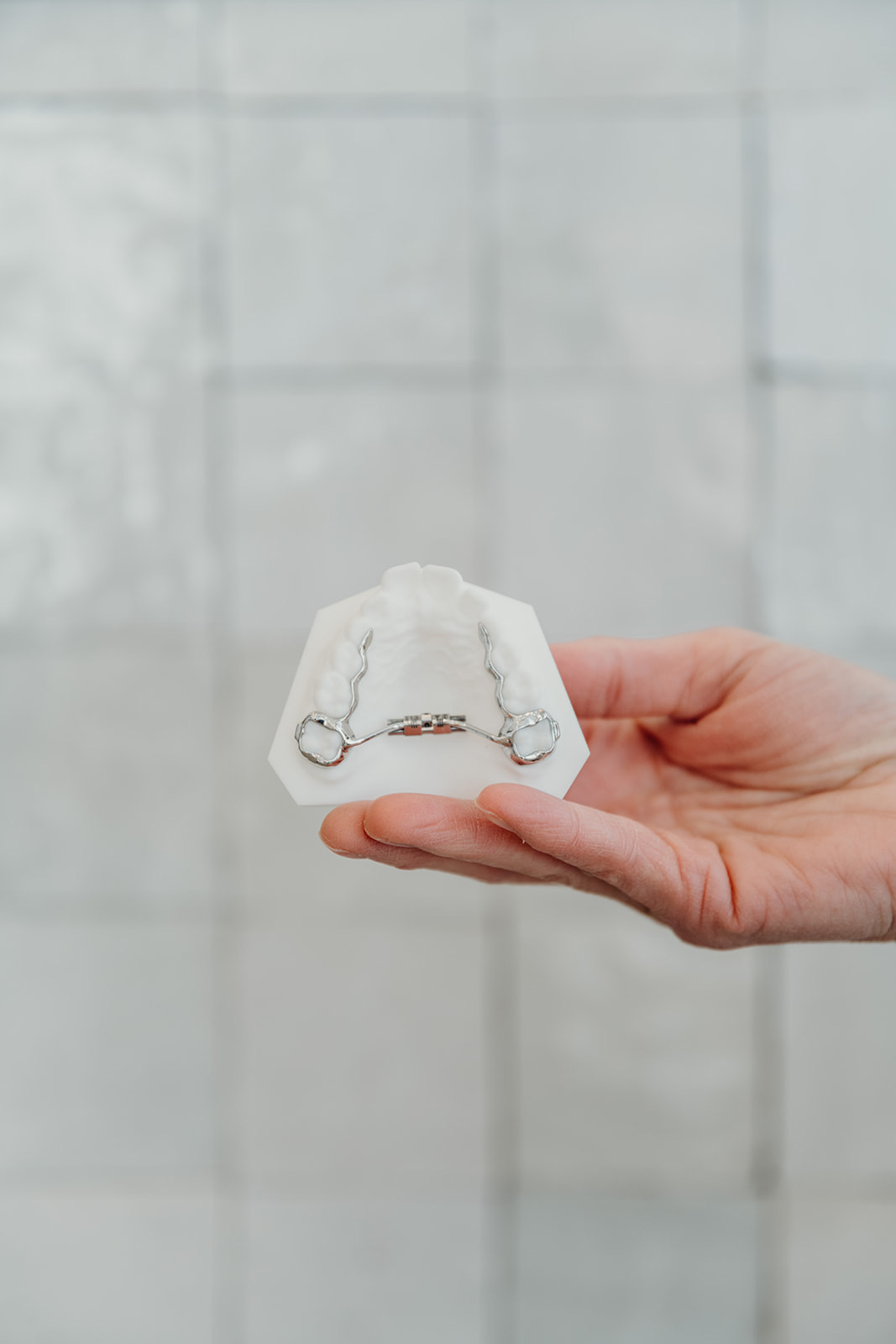 A traditional rapid palatal expander (RPE) on a dental model, held by a clinician at Aligned Orthodontics, an airway orthodontist in Denver. Metal bands cement to the upper back molars and connect to a central screw that widens the palate.