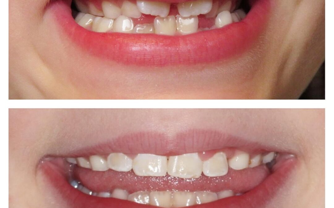 Mouth Breathing and Snoring in Kids: An Honest Look From a Denver Orthodontist
