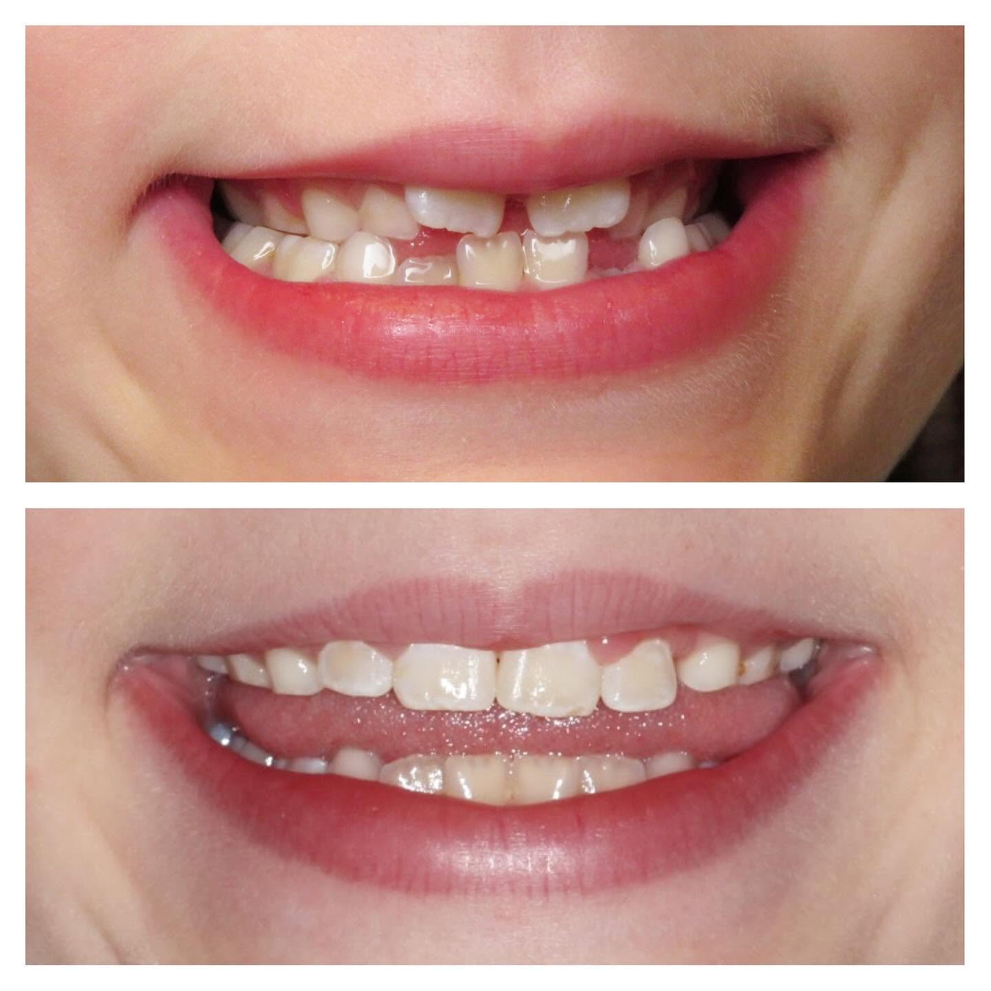 Before and after photos of a child's early orthodontic treatment showing straighter, more evenly aligned teeth, treated by Dr. Amanda Vanderstelt at Aligned Orthodontics in Denver.