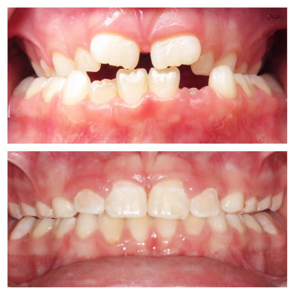Child's open bite before and after early orthodontic treatment in Denver: front teeth apart before, meeting after, treated by Dr. Amanda Vanderstelt at aligned. Orthodontics