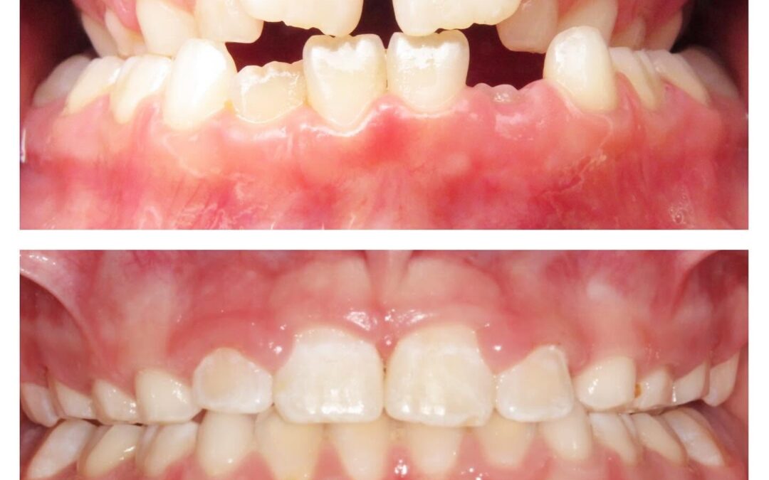 Open Bite Treatment in Denver