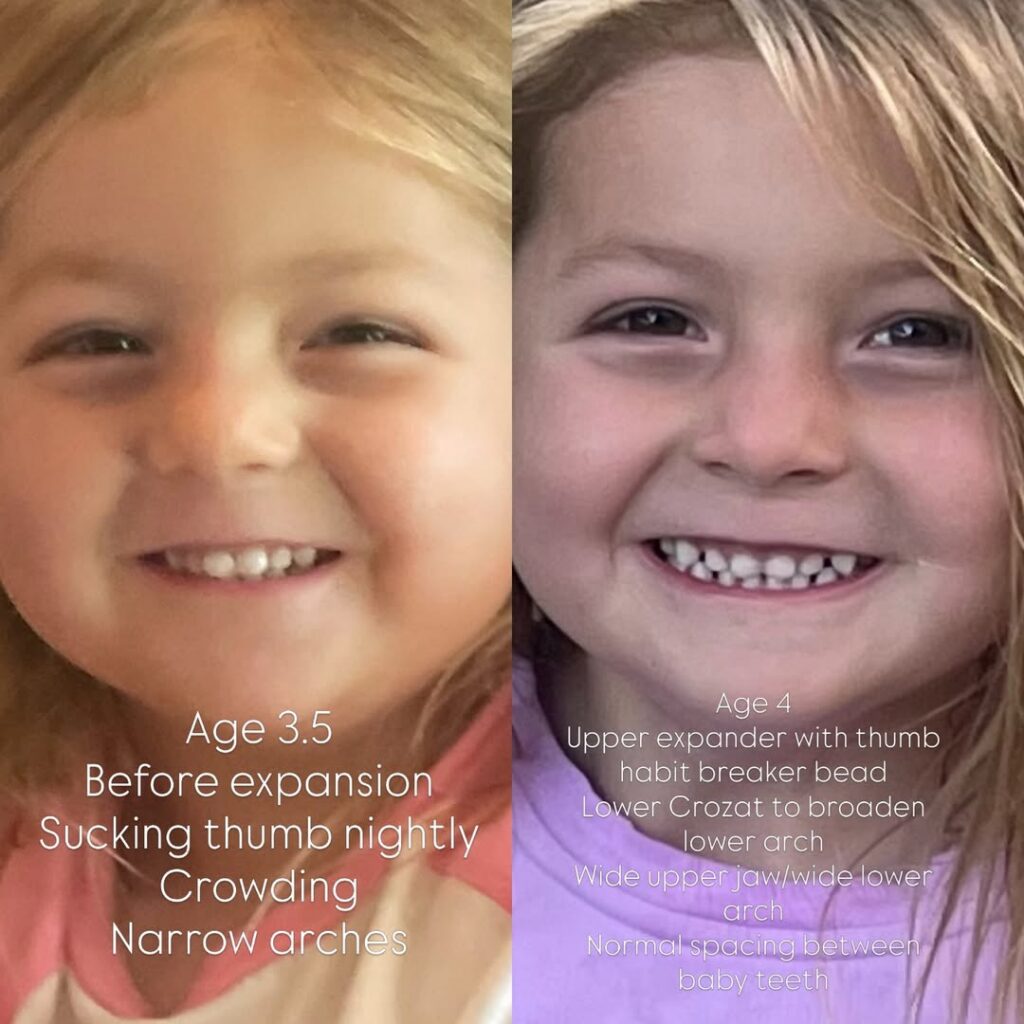 Child’s early palate expansion before and after: narrow, crowded arches at age 3.5, then wider arches at age 4