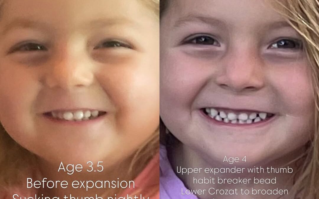 Phase One Orthodontics and Early Treatment in Denver