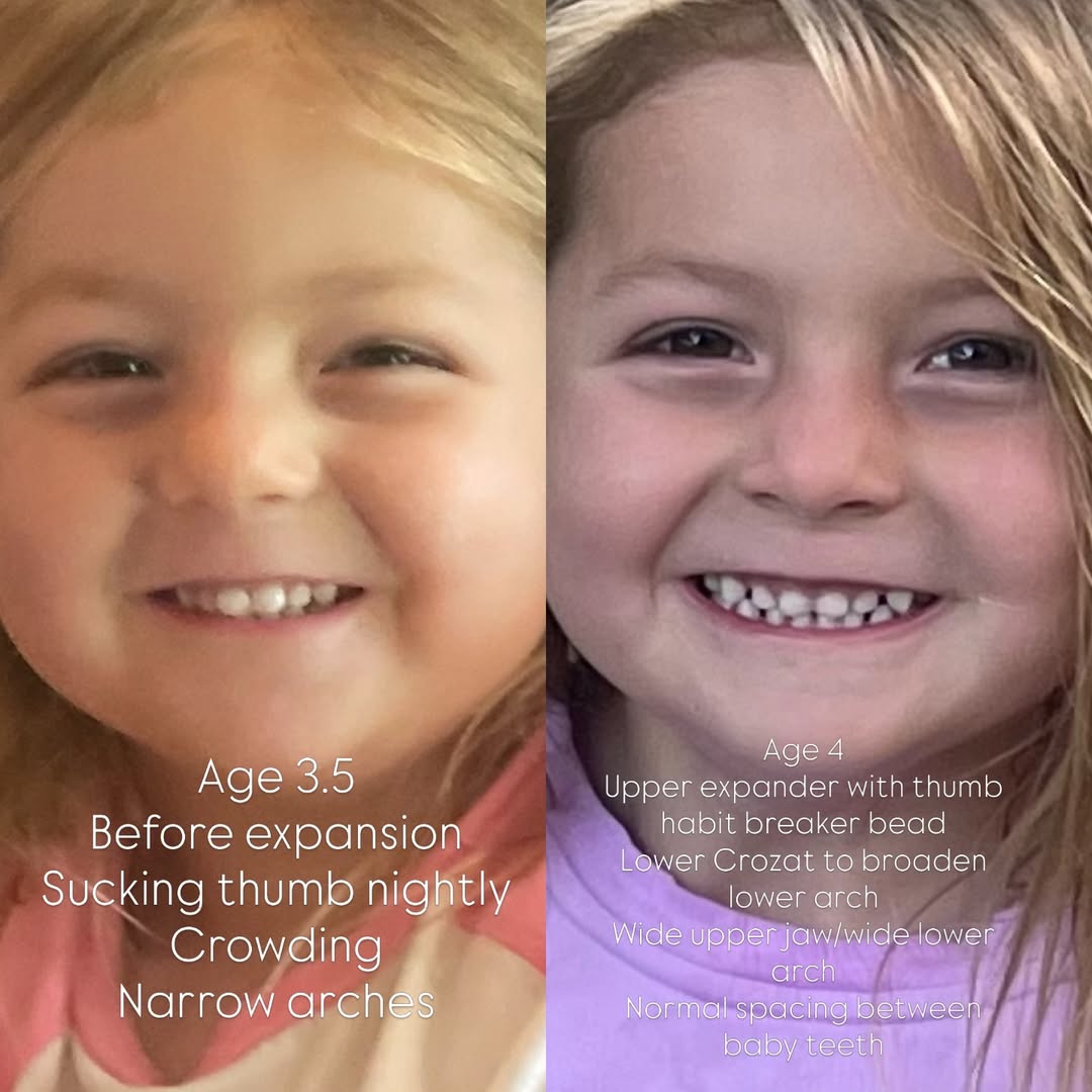 Child's early palate expansion before and after: narrow, crowded arches at age 3.5, then wider arches with even baby-tooth spacing at age 4, treated by Dr. Vanderstelt in Denver
