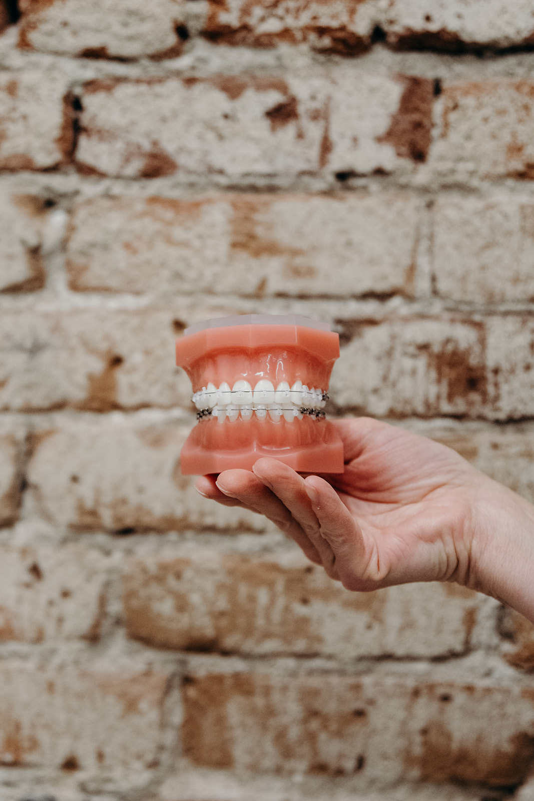 Close-up of clear braces with tooth-colored brackets on a demonstration model at a South Pearl Street orthodontist in Denver