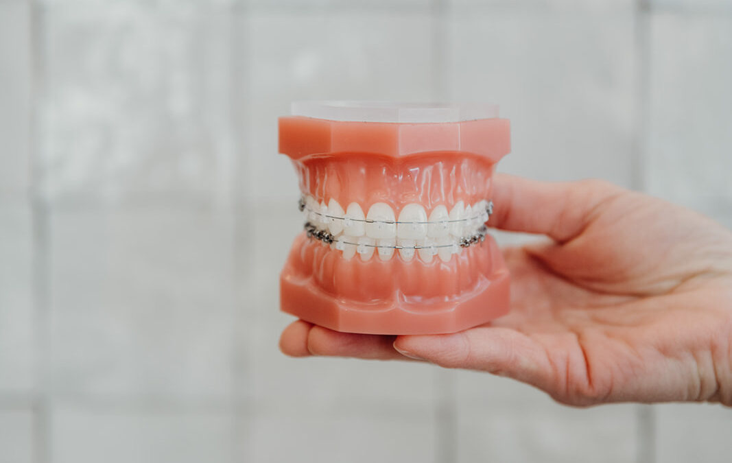 Clear Braces in Denver: Cost, Staining, and What to Expect