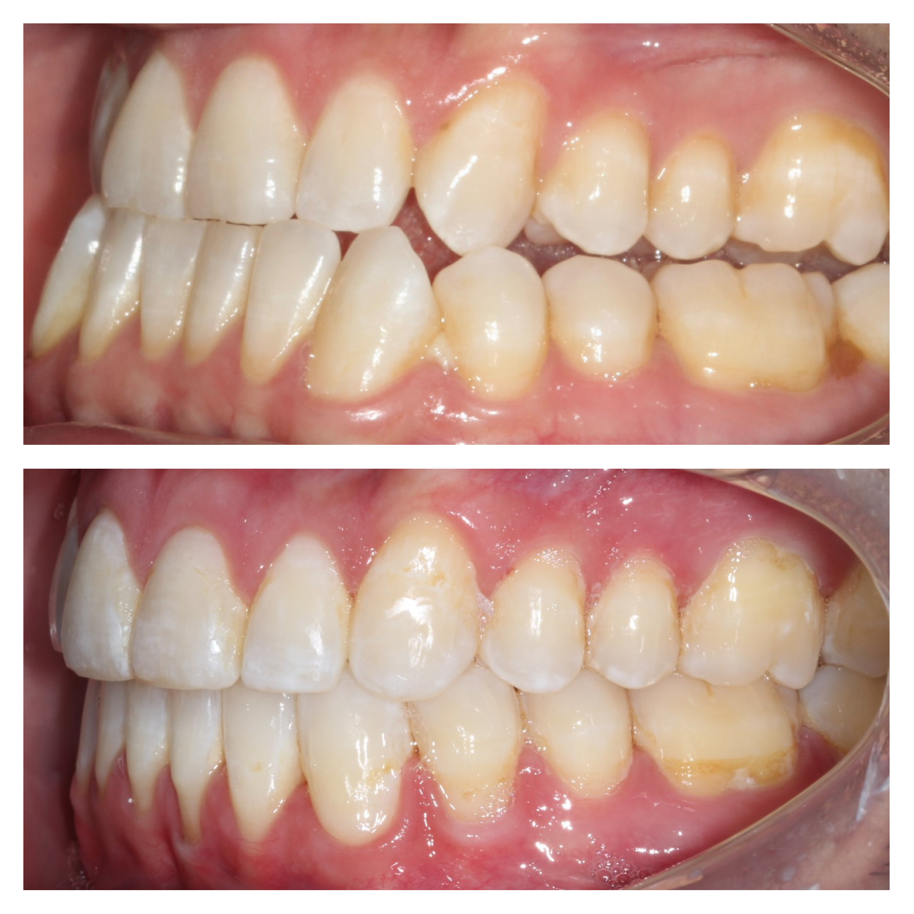 Bite before and after jaw surgery, large overjet corrected to a normal bite, orthodontics by Dr. Vanderstelt in Denver