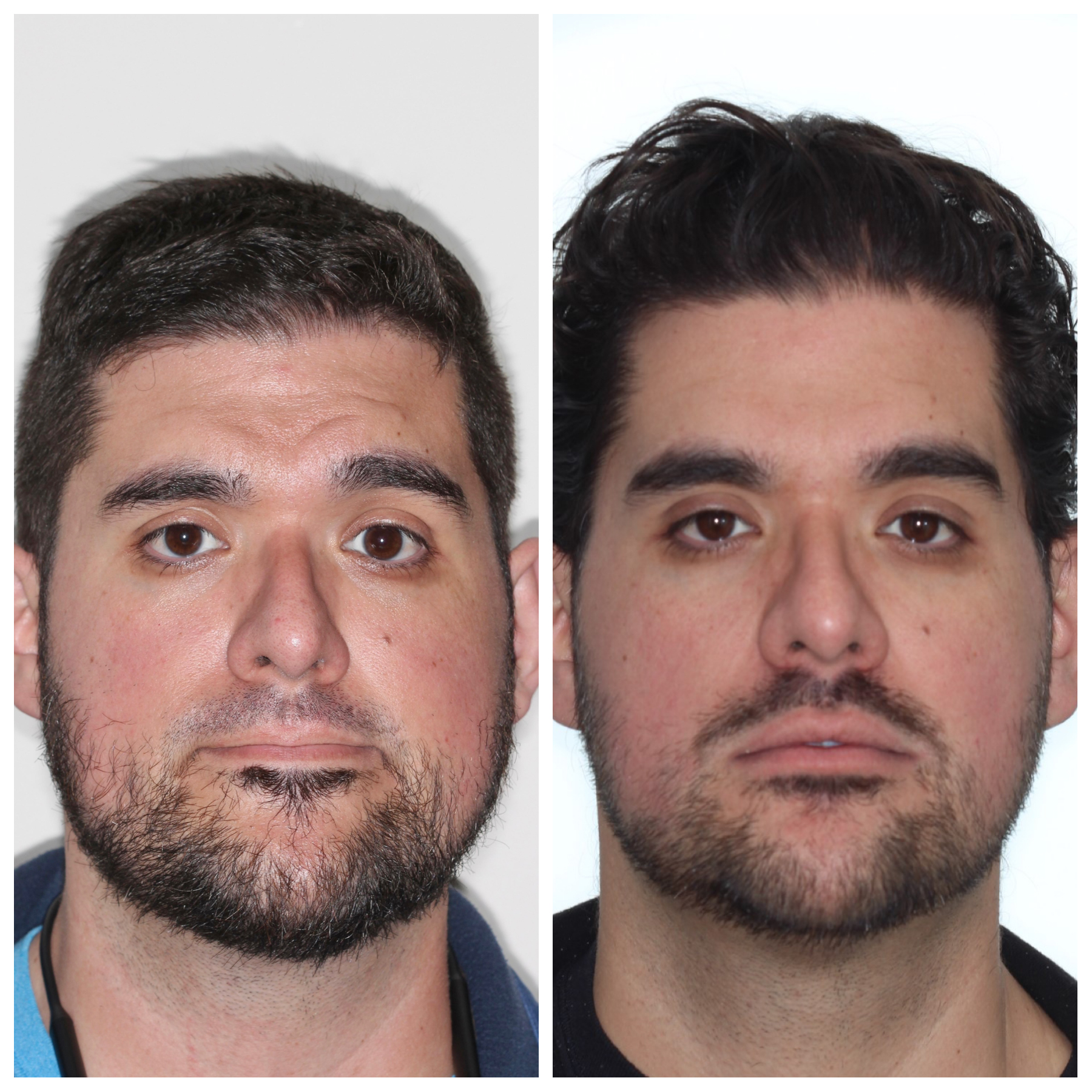 Front facial view before and after jaw surgery showing improved lower face balance, orthodontics by Dr. Vanderstelt in Denver