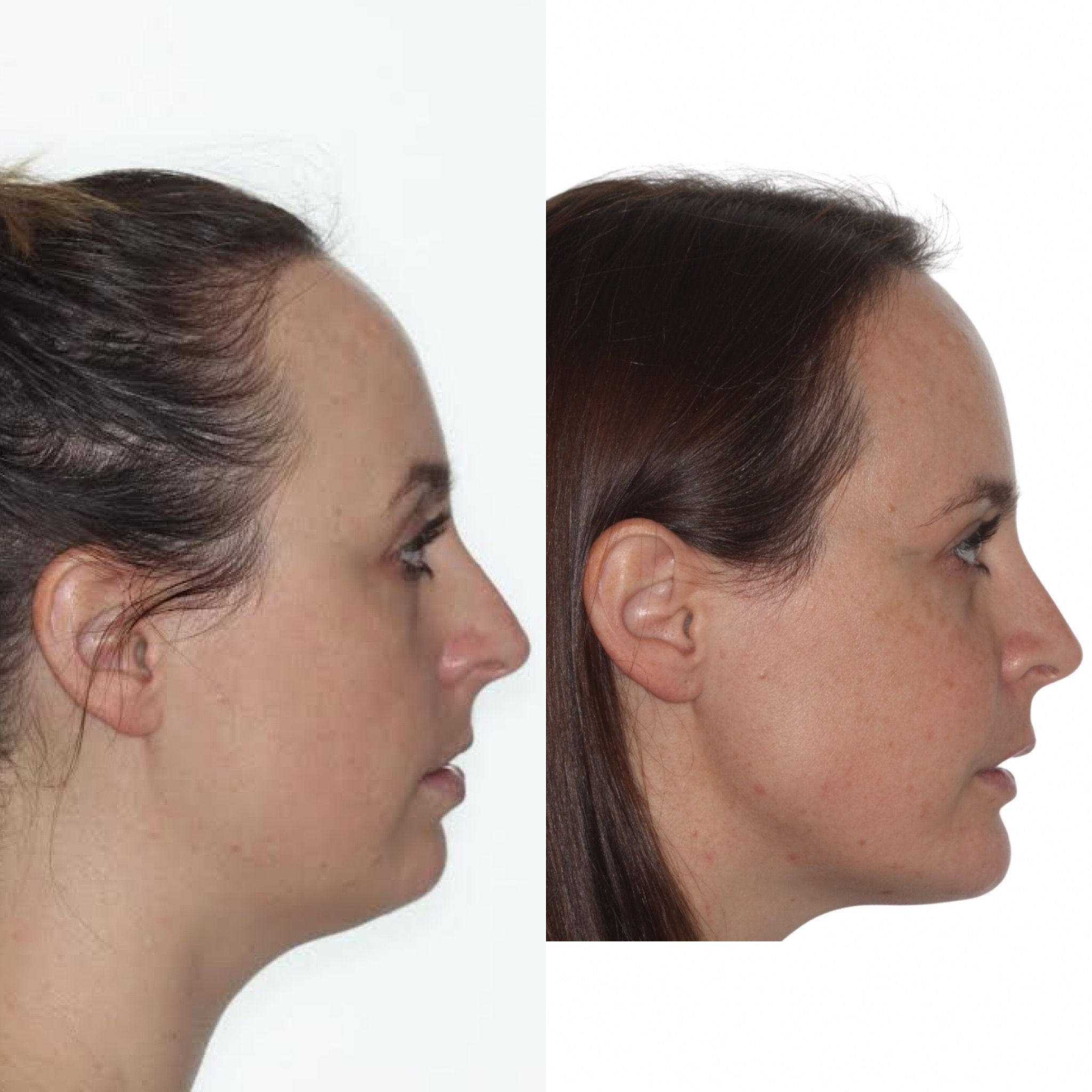 Profile before and after jaw surgery for both jaws recessed, orthodontics by Dr. Vanderstelt in Denver