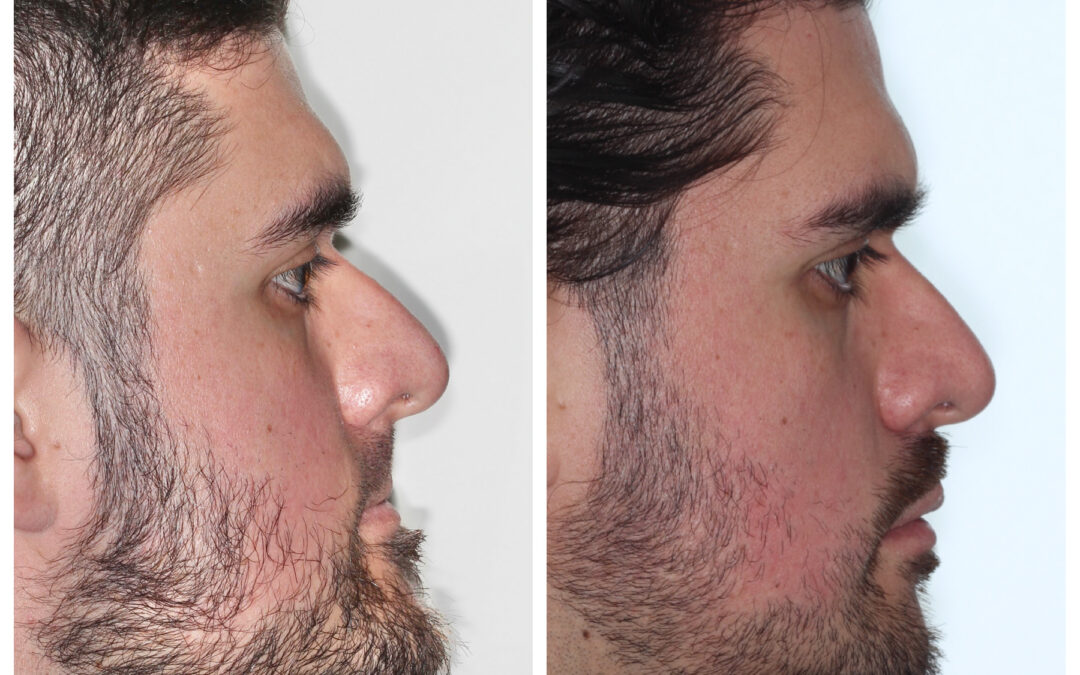 Jaw Surgery for Sleep Apnea in Denver
