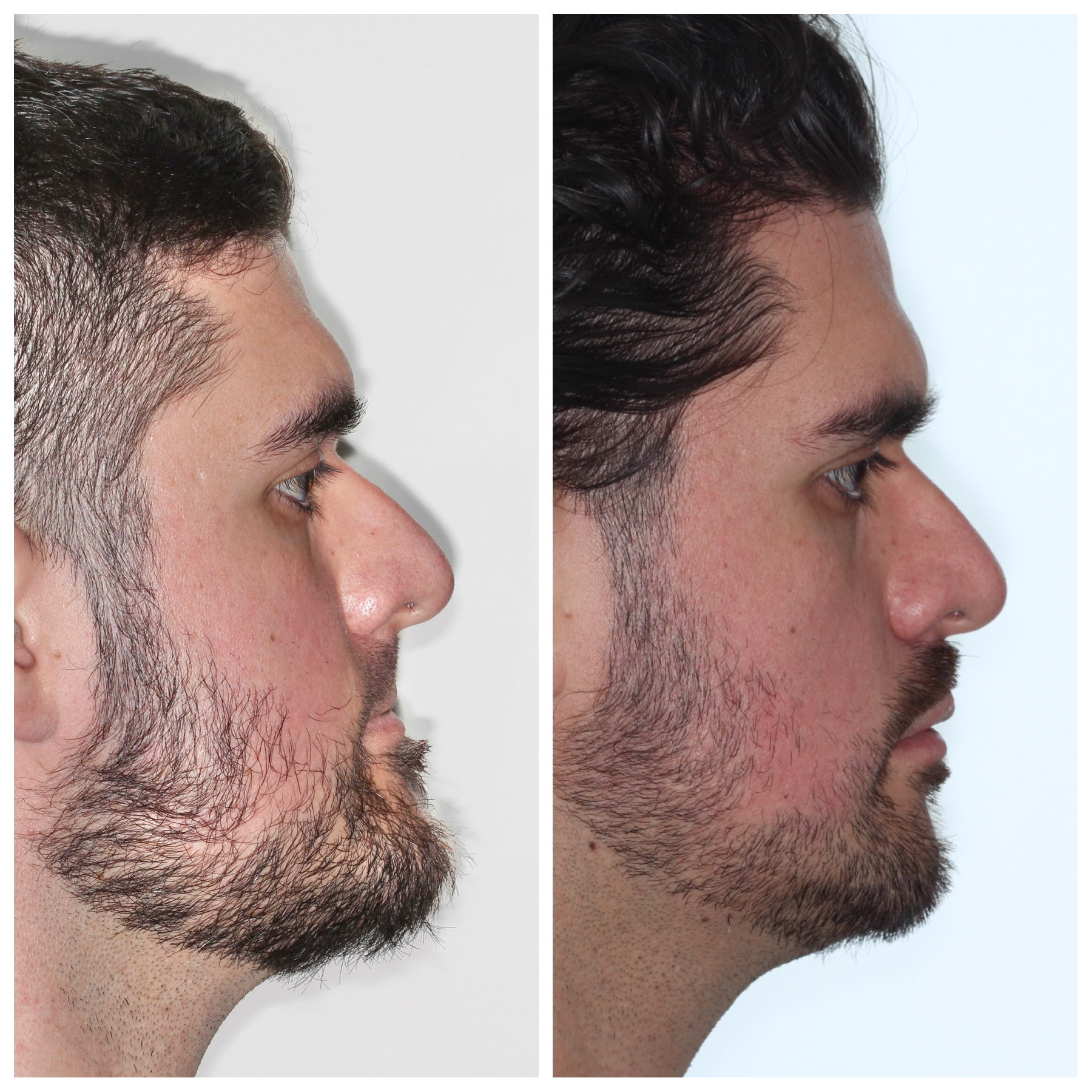 Profile before and after jaw surgery showing improved jawline and chin projection, orthodontics by Dr. Vanderstelt in Denver