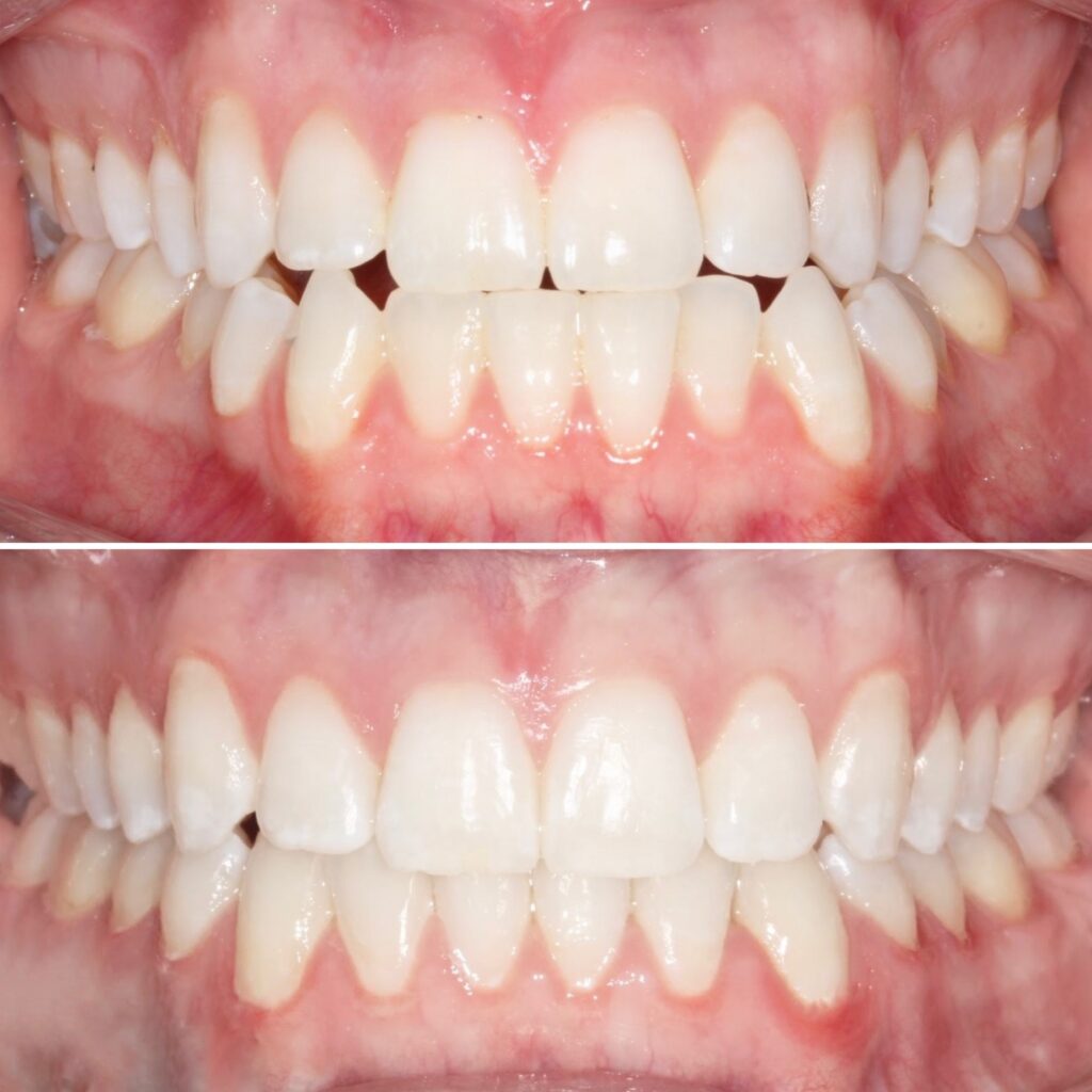 Adult skeletal open bite before and after jaw surgery with orthodontics in Denver: front teeth apart before, closed after, orthodontics by Dr. Amanda Vanderstelt