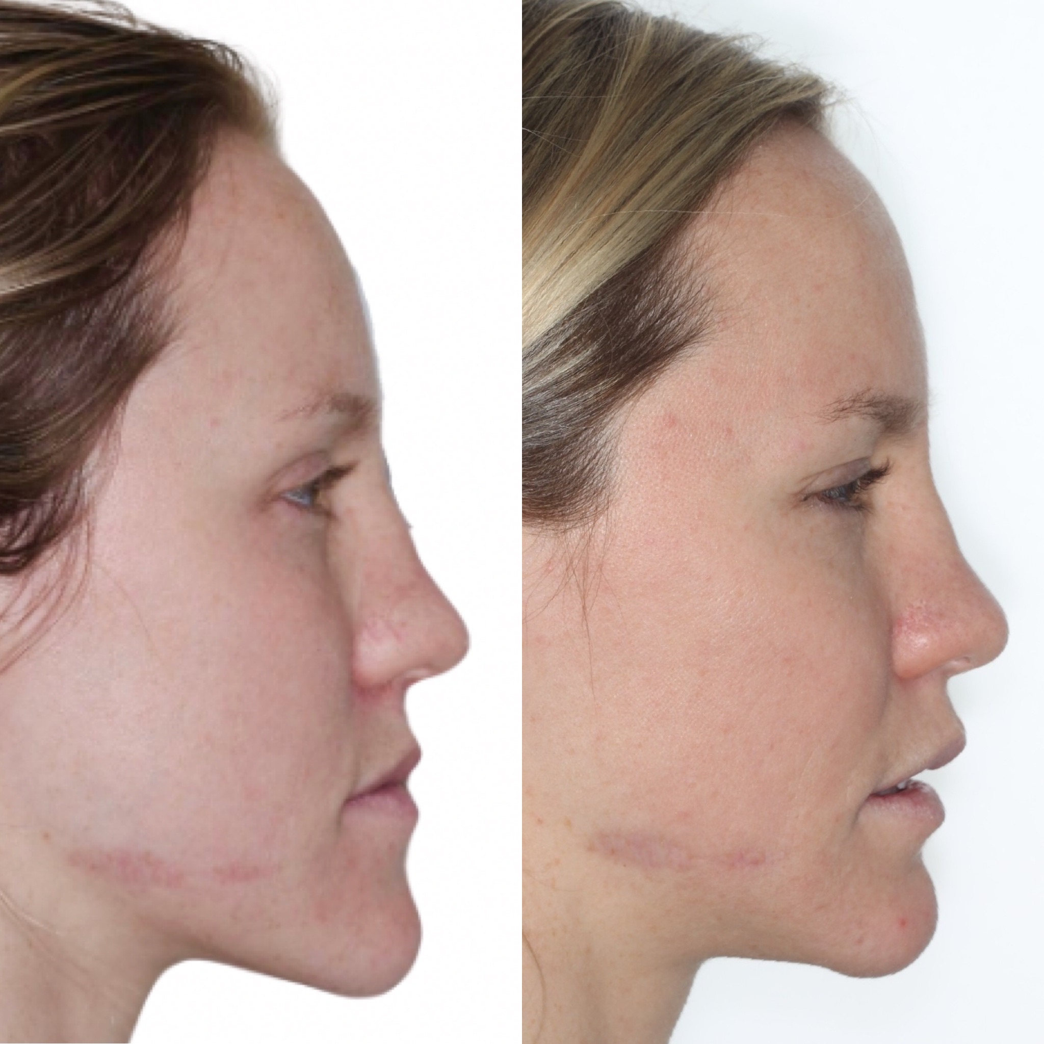 Profile before and after jaw surgery for an open bite, orthodontics by Dr. Vanderstelt in Denver