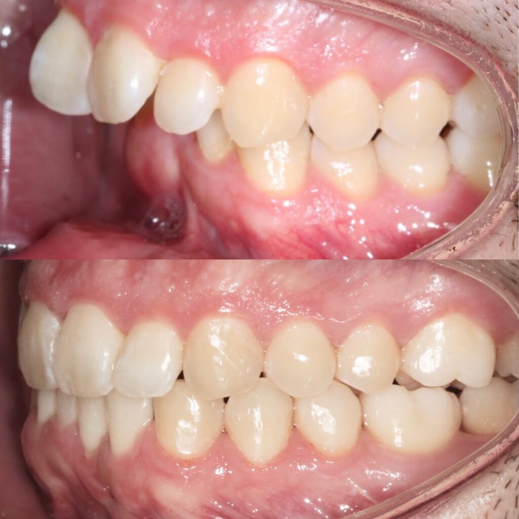 Side view of the bite showing the overjet before and after jaw surgery, orthodontics by Dr. Vanderstelt in Denver