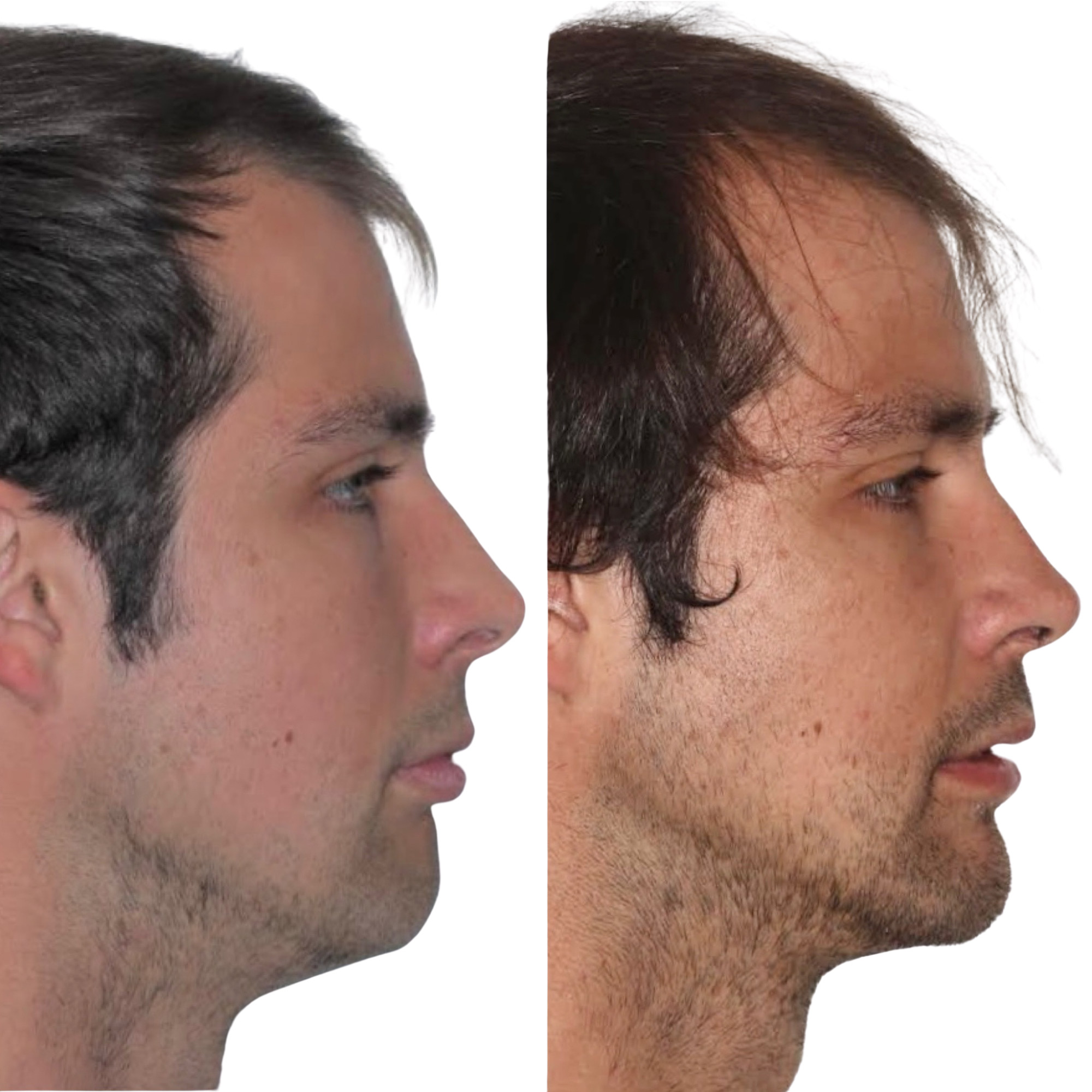 Profile before and after jaw surgery for a deep overbite, orthodontics by Dr. Vanderstelt in Denver