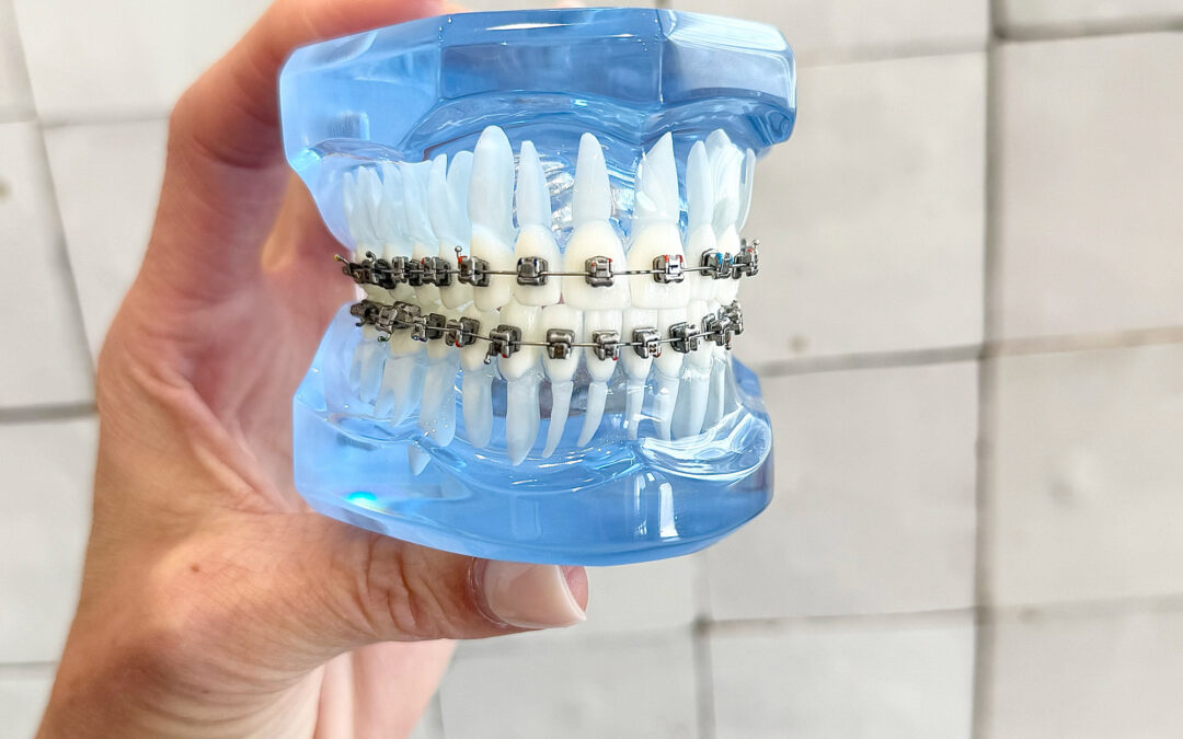 Metal Braces in Denver: Cost, Options, and Why They Still Win