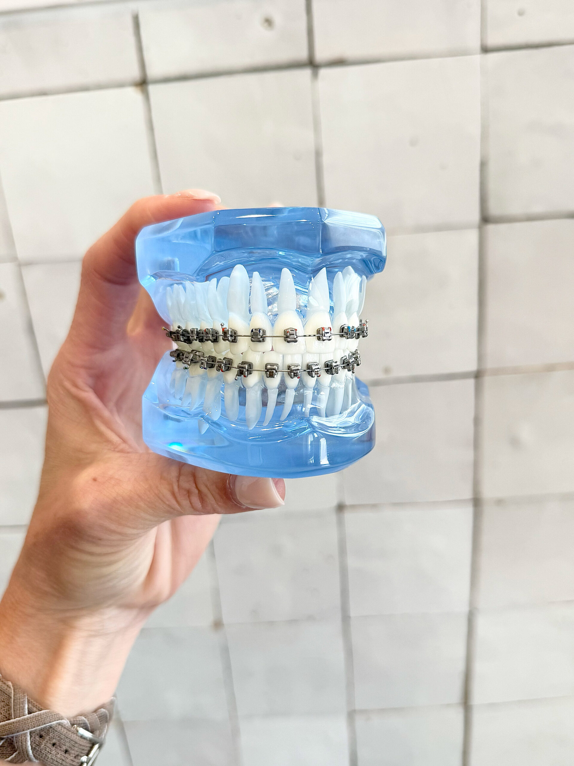Metal braces with self-ligating brackets on a dental model at aligned. Orthodontics in Denver