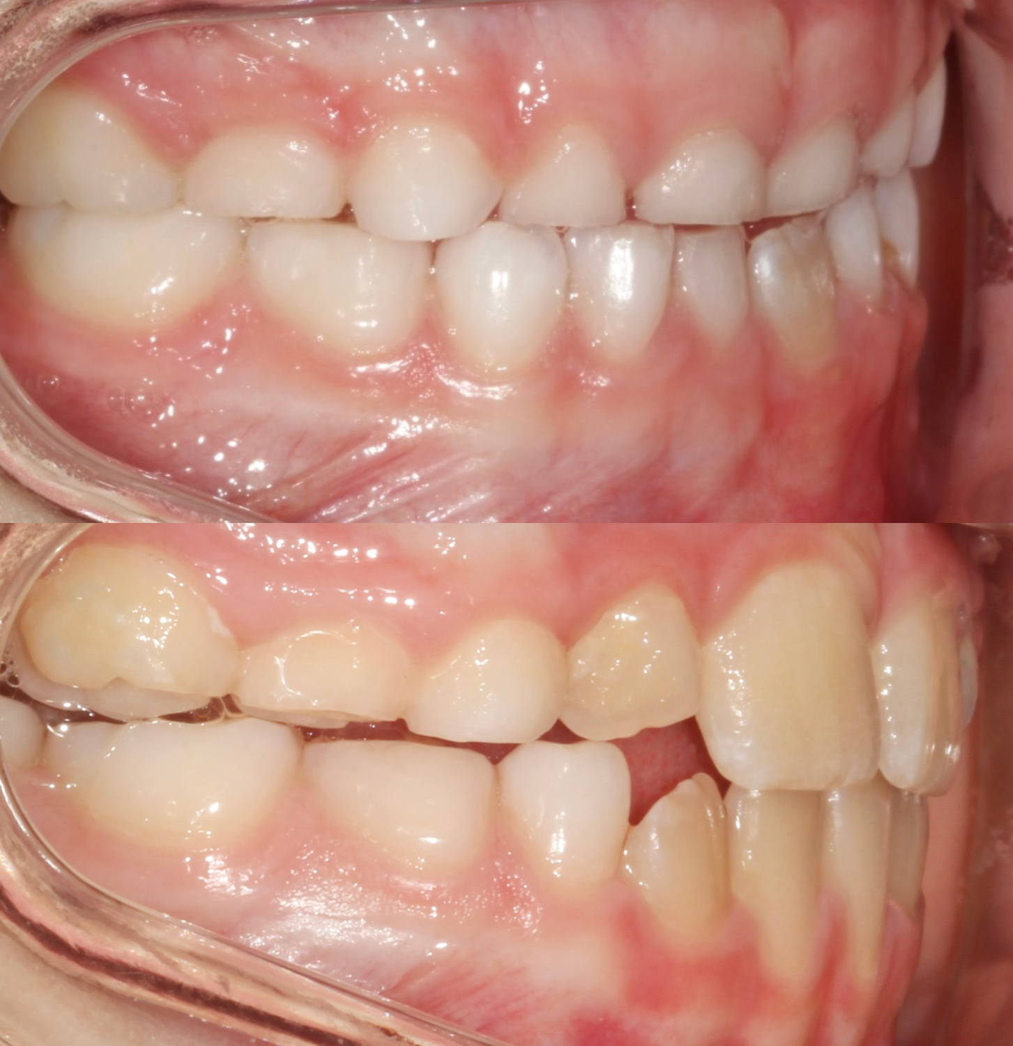 Class III underbite correction Denver before and after side bite view