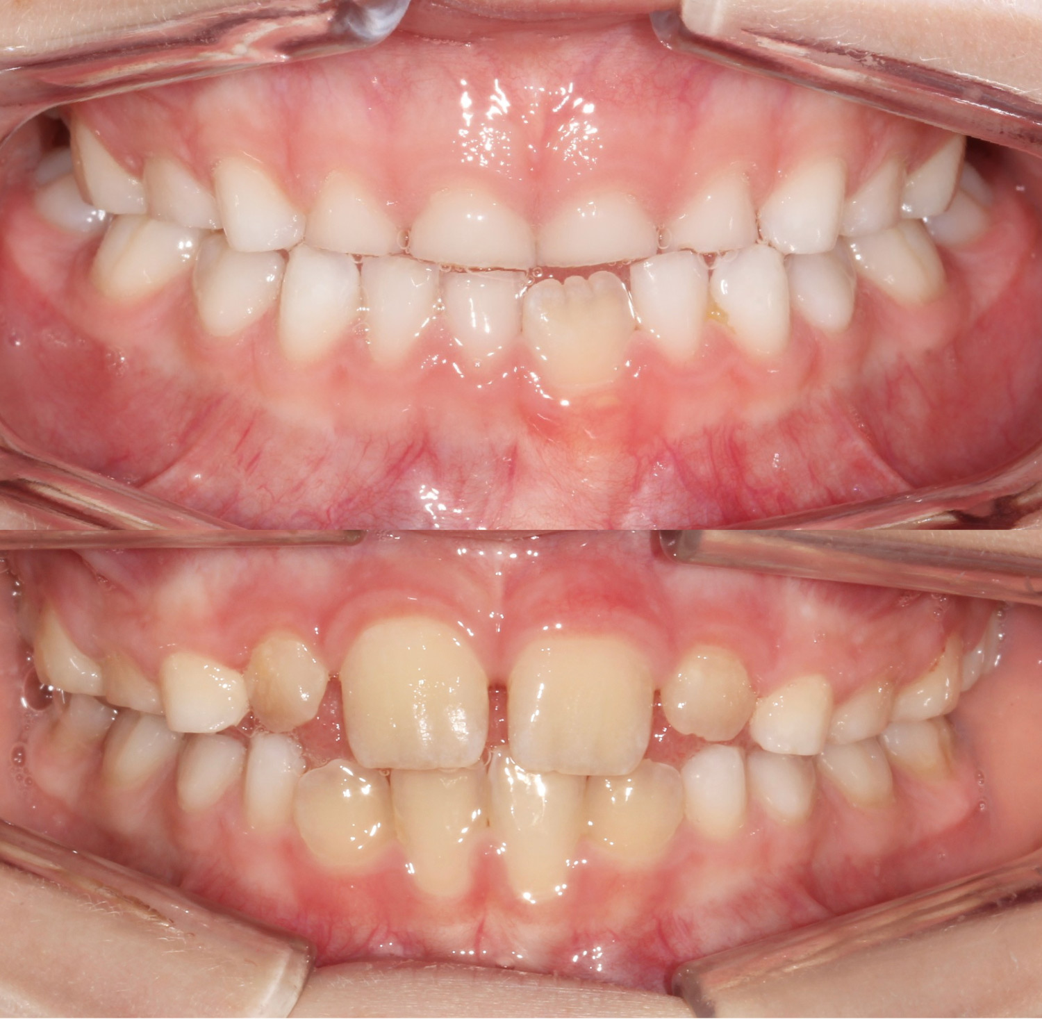 Underbite treatment Denver before and after front teeth view