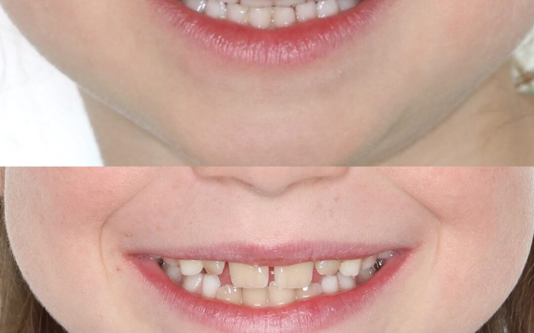 Underbite Treatment in Denver: Start With the Jaw Everyone Overlooks