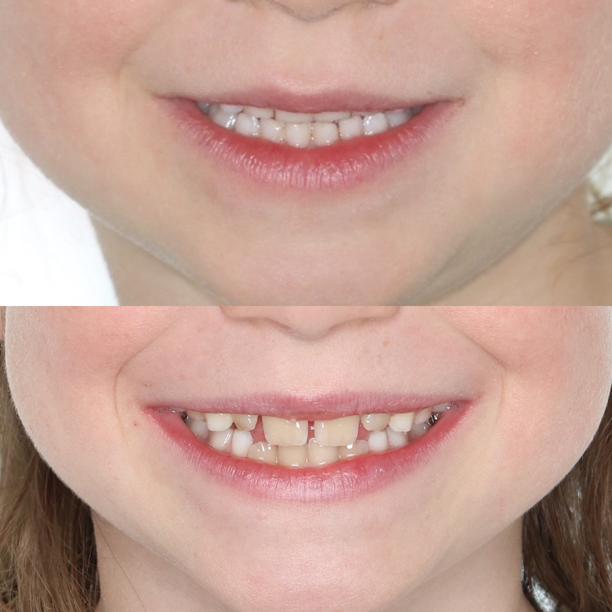 Underbite before and after treatment in Denver, child smile corrected with Phase 1 expander and facemask