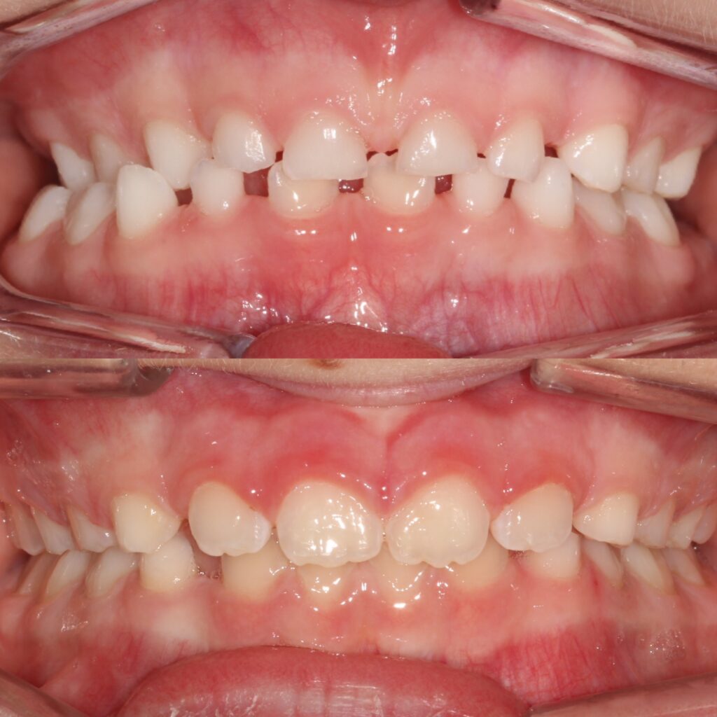 Crossbite before and after in Denver: retracted view of the bite before treatment above and after palate expansion and clear aligners below, at aligned. Orthodontics