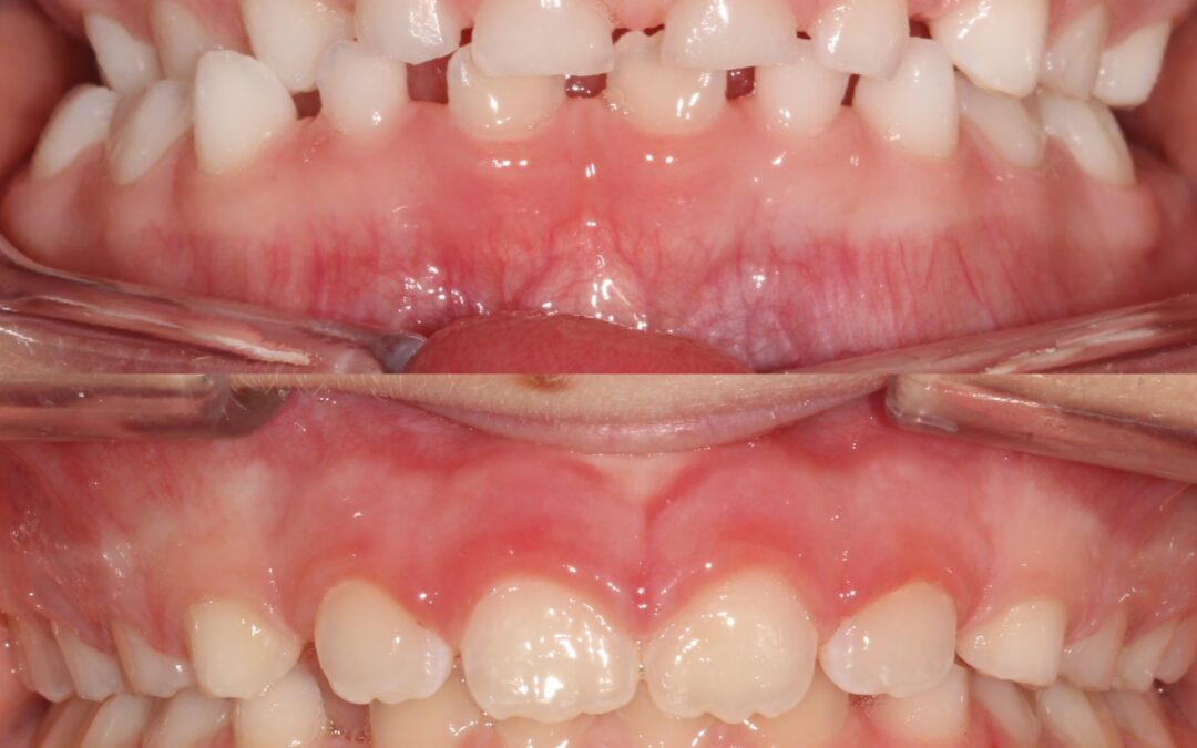 Crossbite Treatment in Denver
