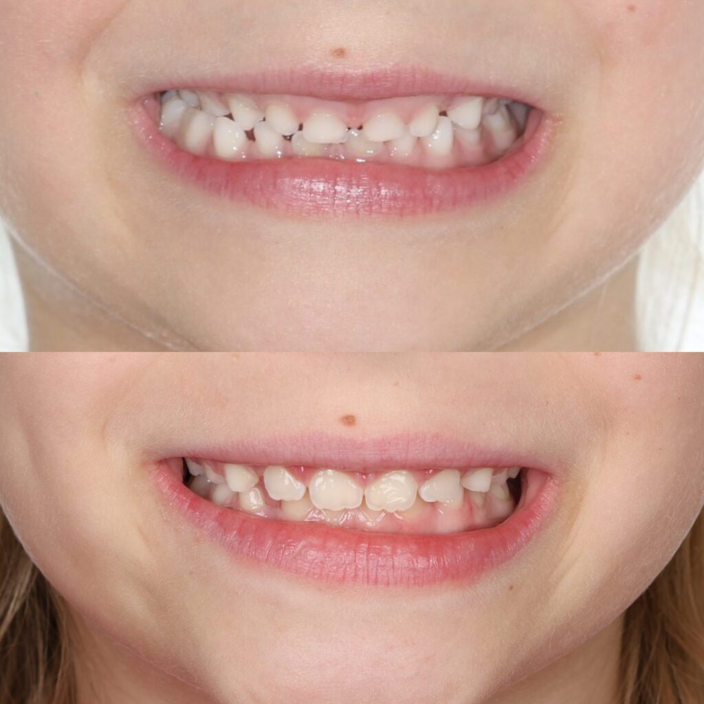 Crossbite before and after in Denver: child's smile before treatment above and after Phase 1 palate expansion and clear aligners below, at aligned. Orthodontics