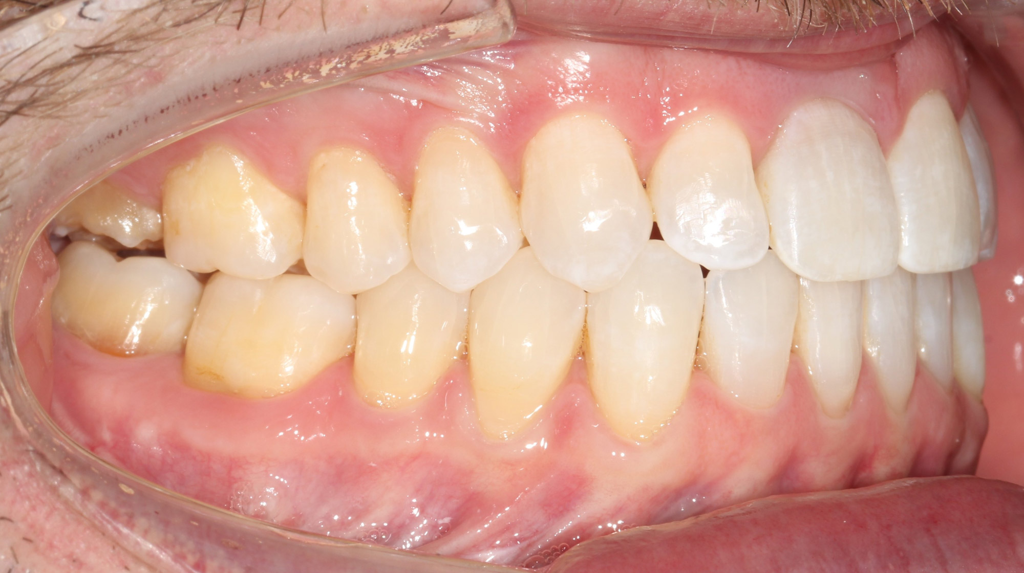 Side view of the corrected bite after open bite jaw surgery, Dr. Vanderstelt in Denver