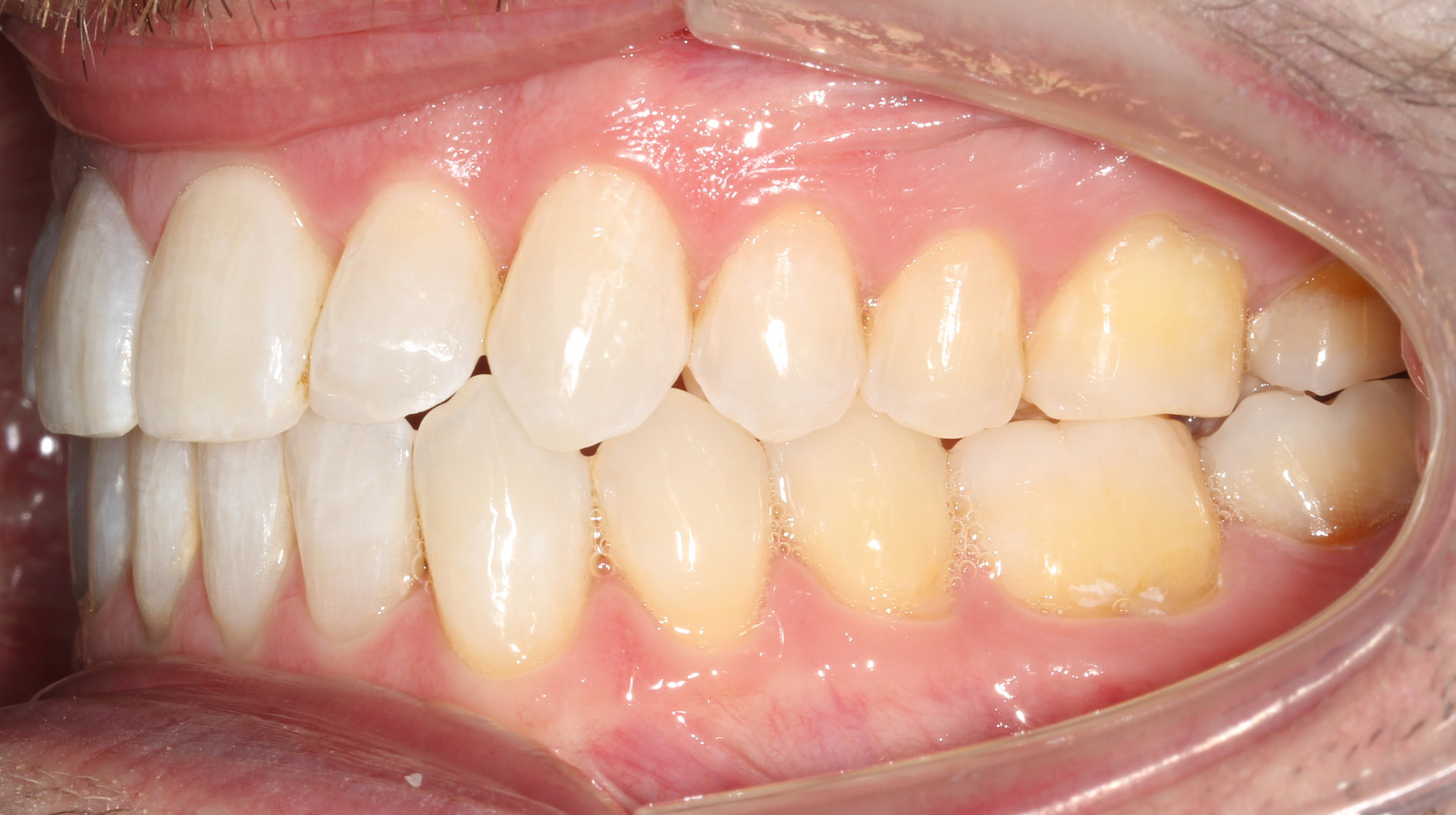 Side view of the corrected bite after open bite jaw surgery, Dr. Vanderstelt in Denver
