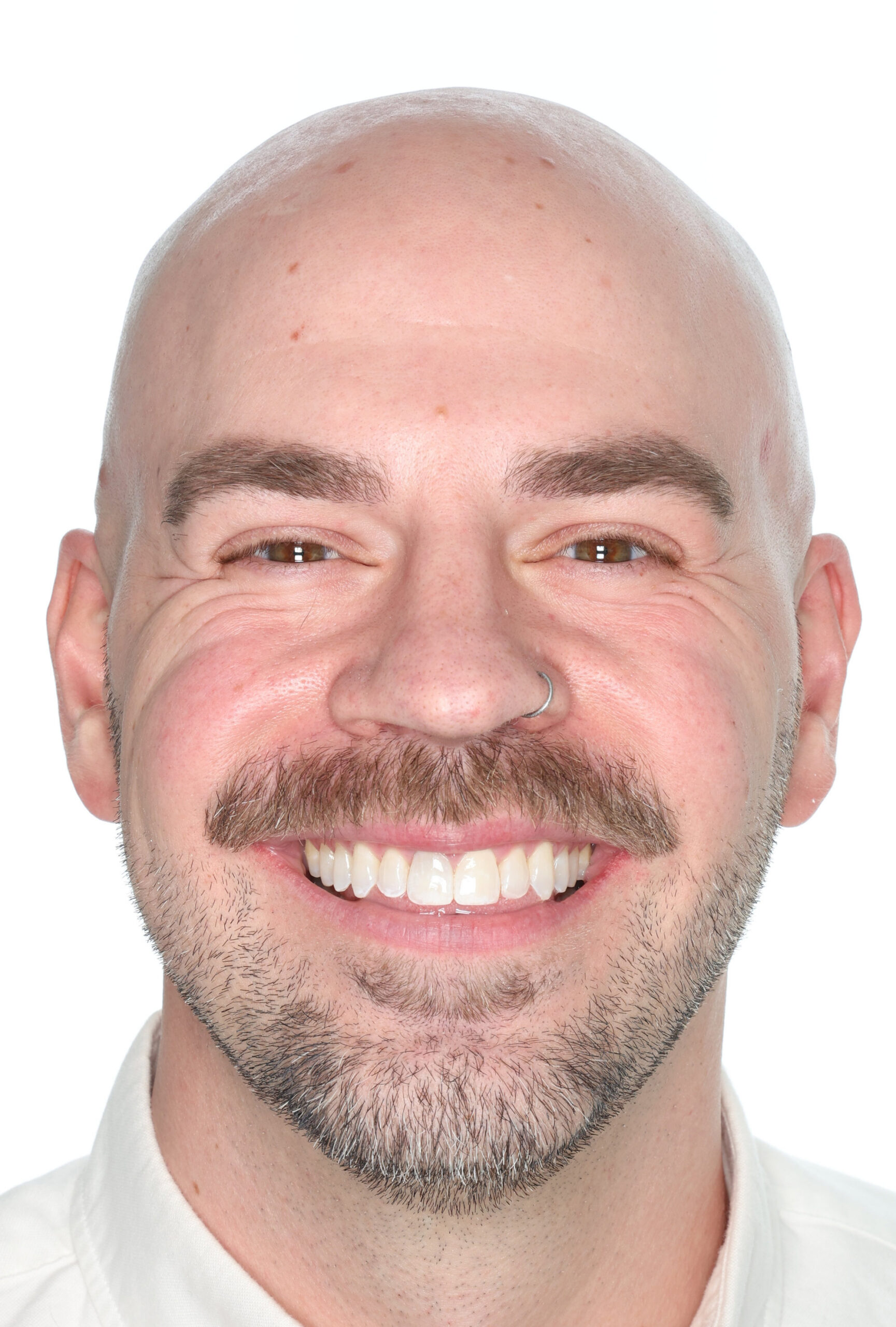 Front smile after jaw surgery for an open bite, fuller and more balanced smile, Dr. Vanderstelt in Denver
