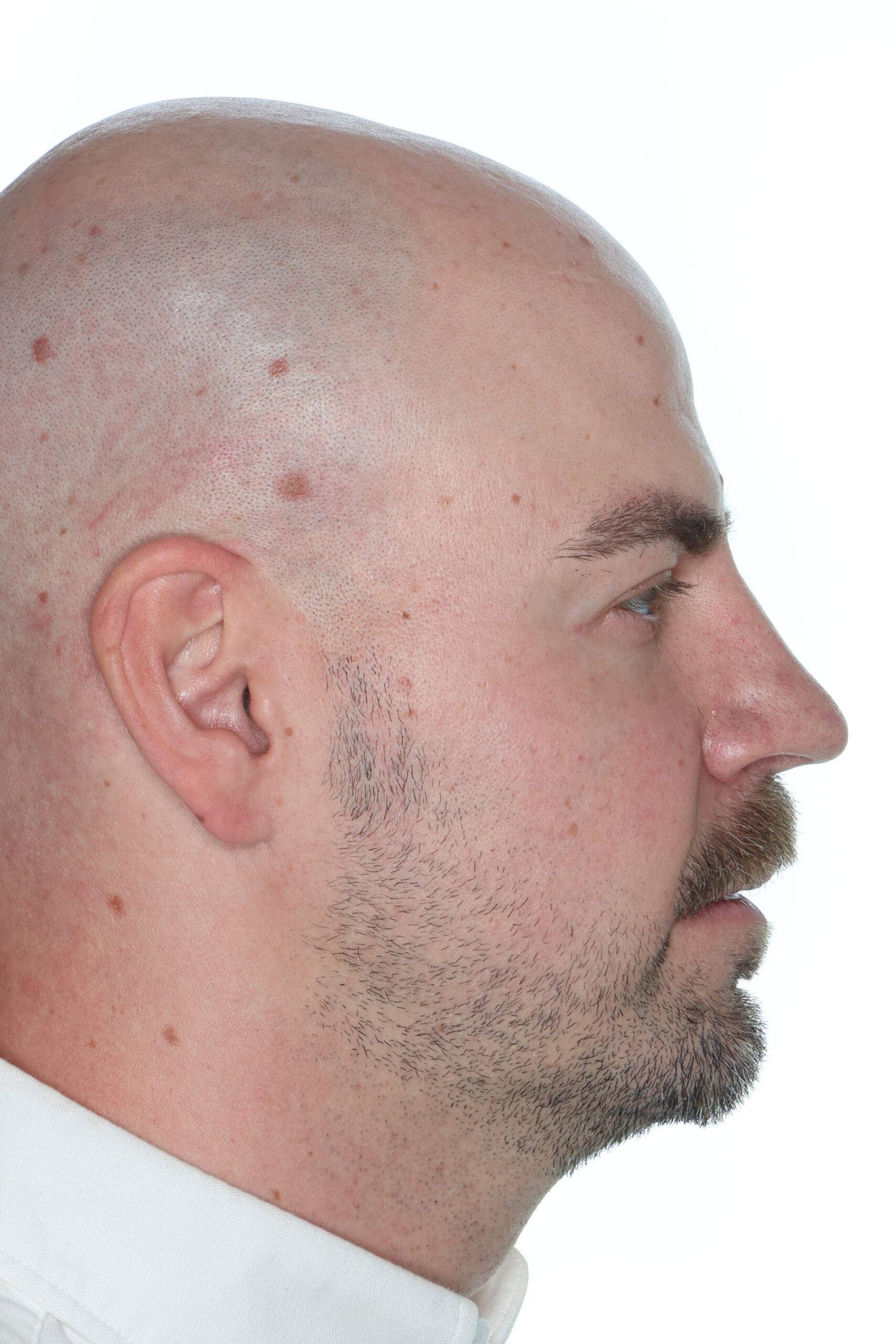 Profile after jaw surgery for a narrow upper jaw and open bite, improved jawline, Dr. Vanderstelt in Denver