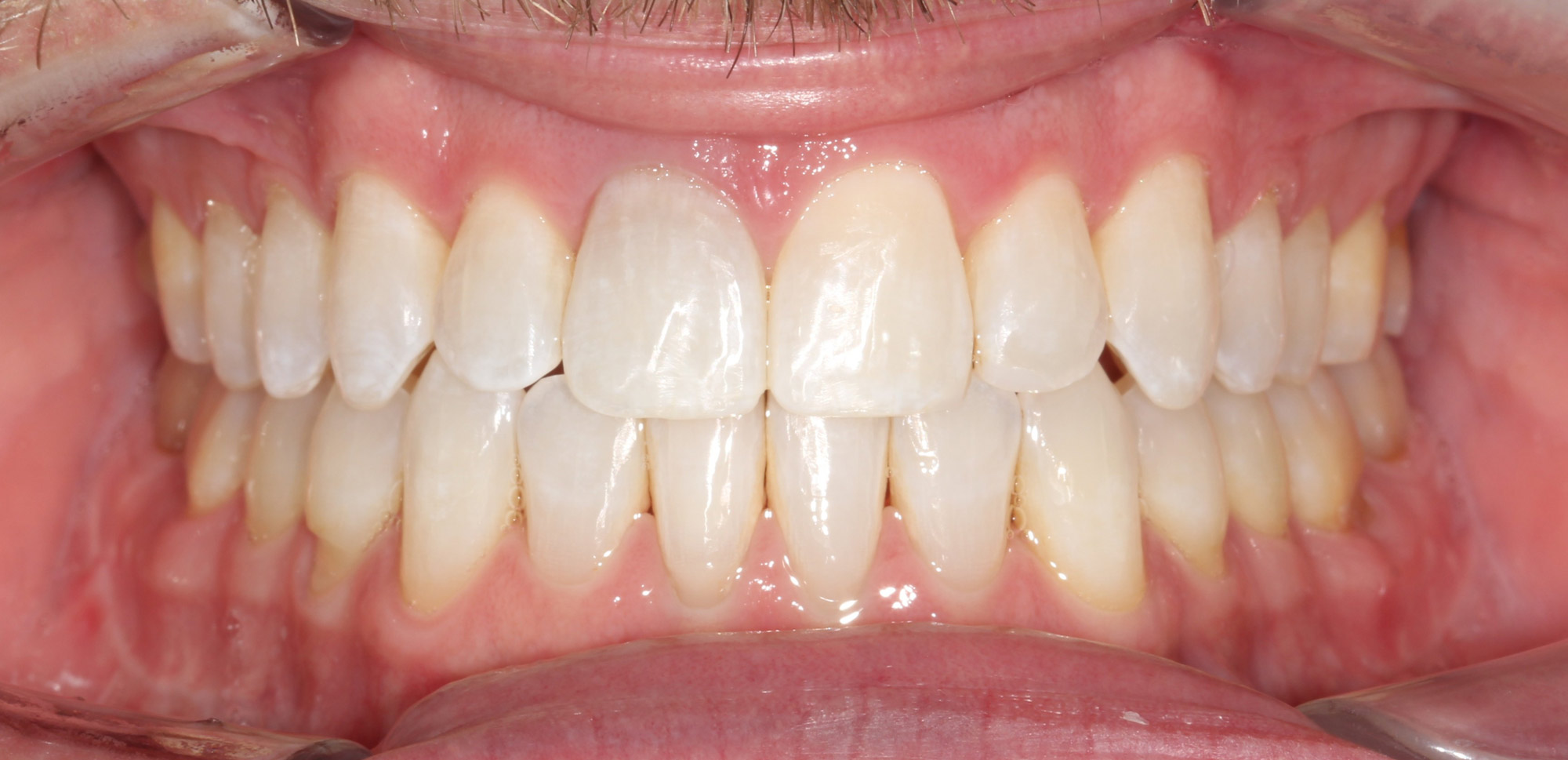 Bite after open bite jaw surgery, front teeth now meeting, Dr. Vanderstelt in Denver