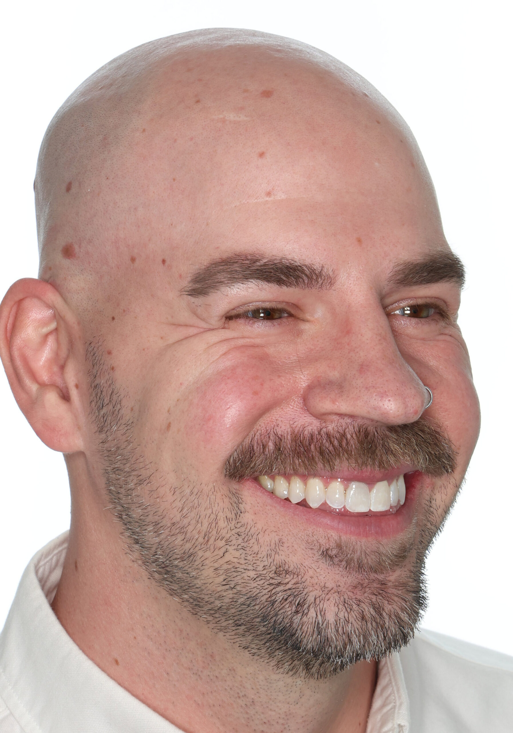 Three-quarter view after jaw surgery for an open bite, improved facial balance, Dr. Vanderstelt in Denver