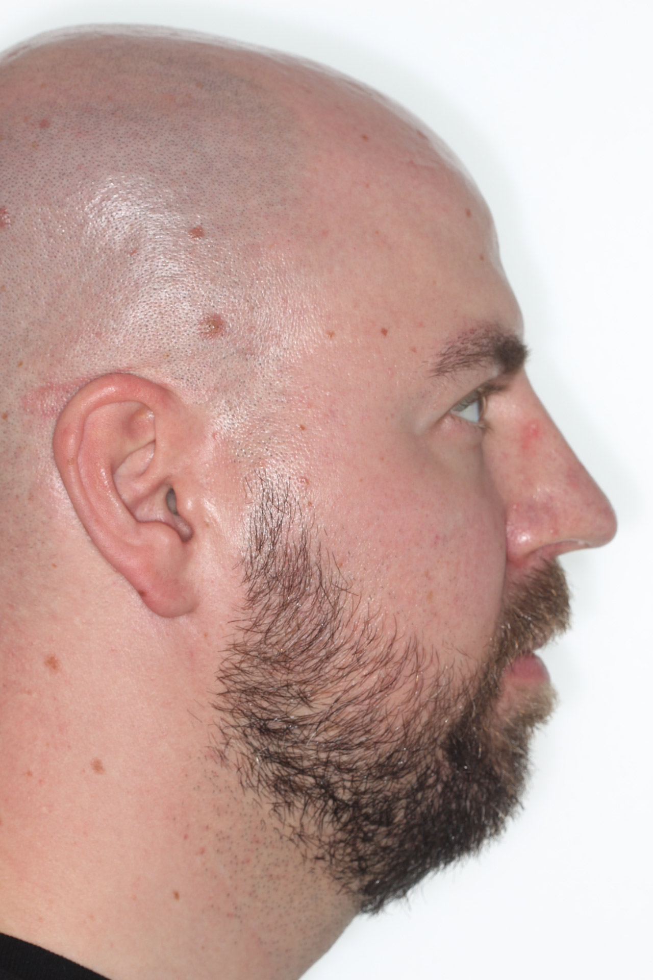 Profile before jaw surgery for a narrow upper jaw and open bite, orthodontics by Dr. Vanderstelt in Denver
