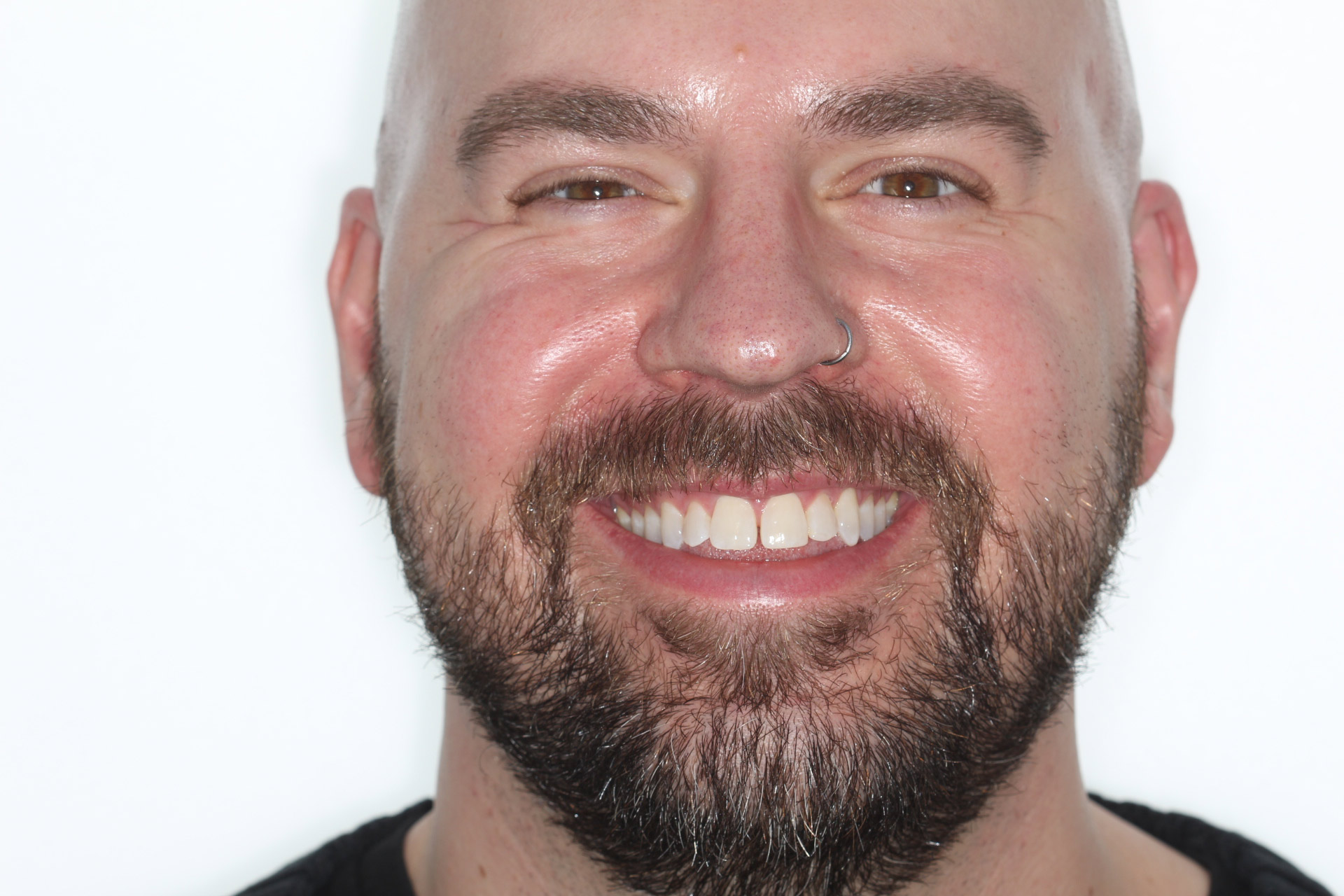 Front smile before jaw surgery for an open bite and narrow upper jaw, orthodontics by Dr. Vanderstelt in Denver
