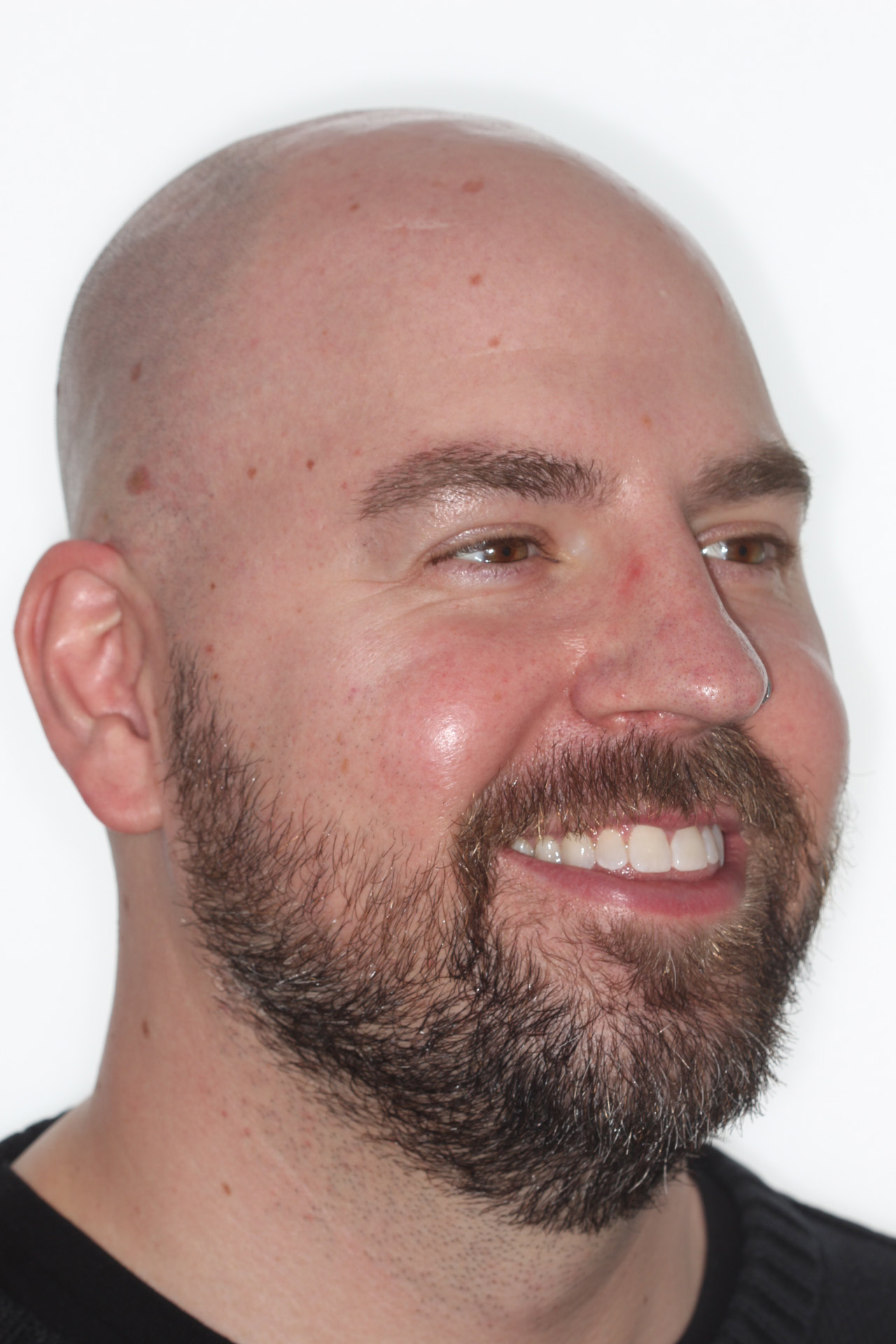 Three-quarter view before jaw surgery for an open bite, orthodontics by Dr. Vanderstelt in Denver