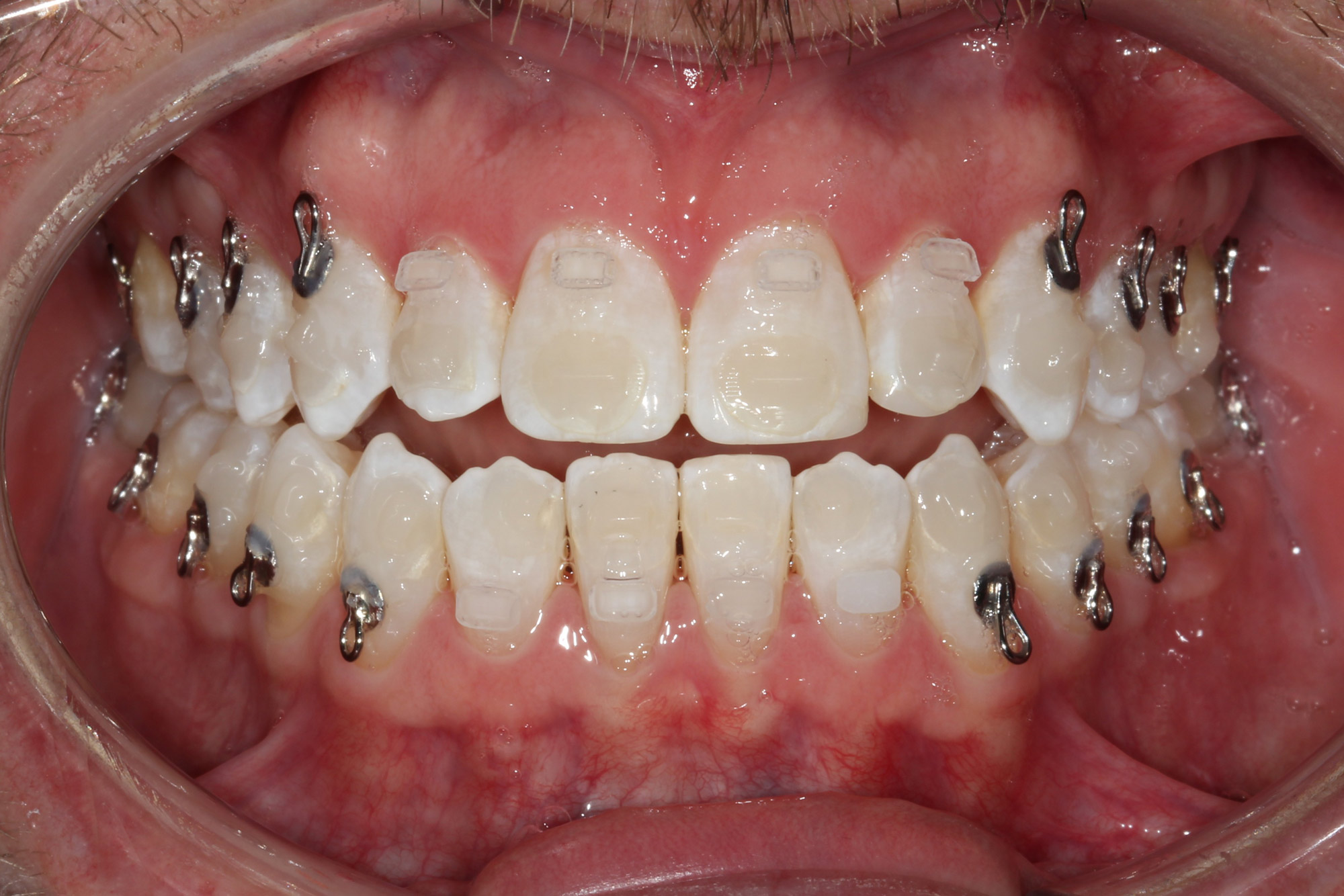 Open bite before correction, front teeth not meeting, Dr. Vanderstelt in Denver