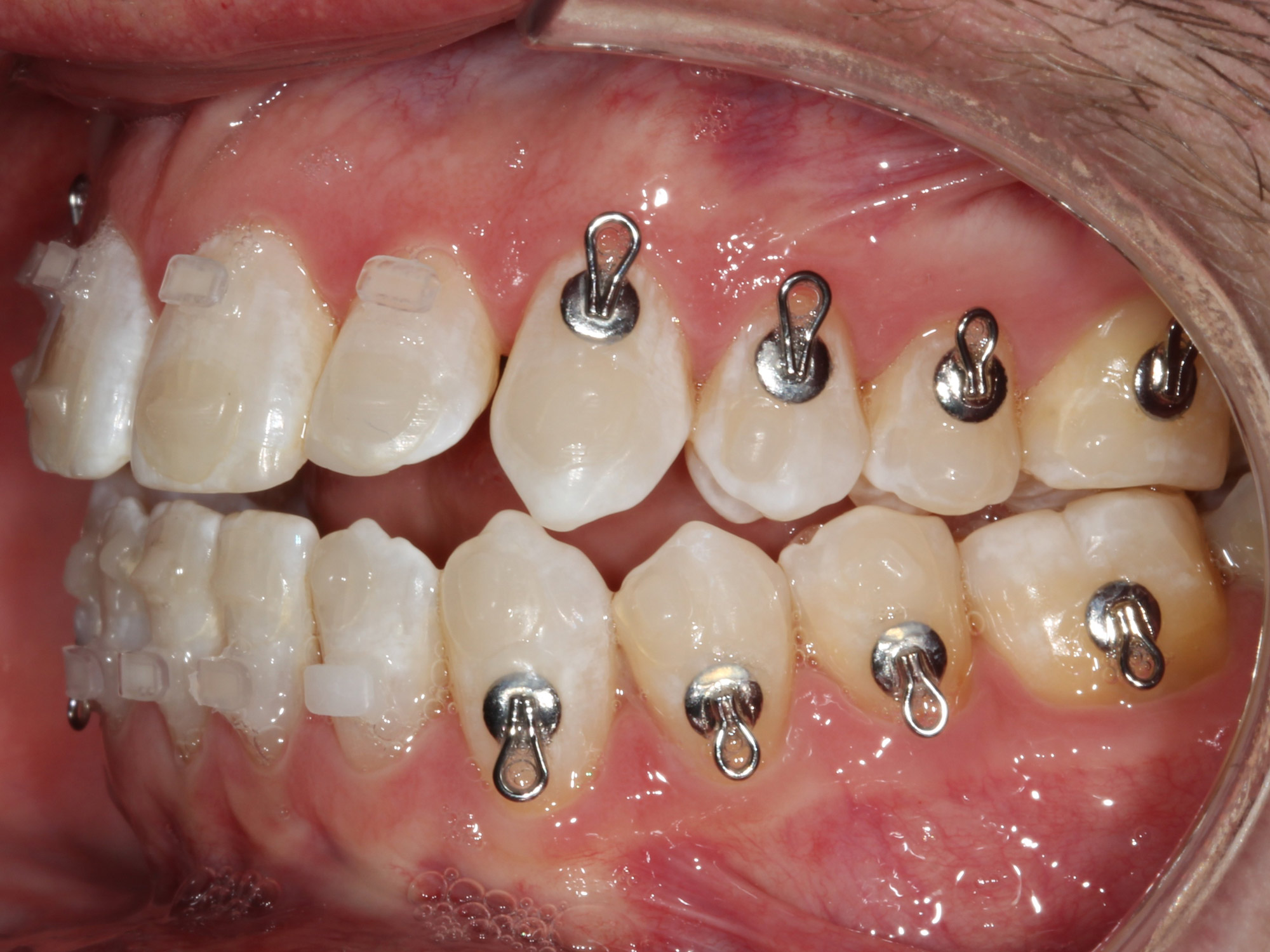 Side view of the bite during pre-surgical orthodontics before open bite jaw surgery, Dr. Vanderstelt in Denver