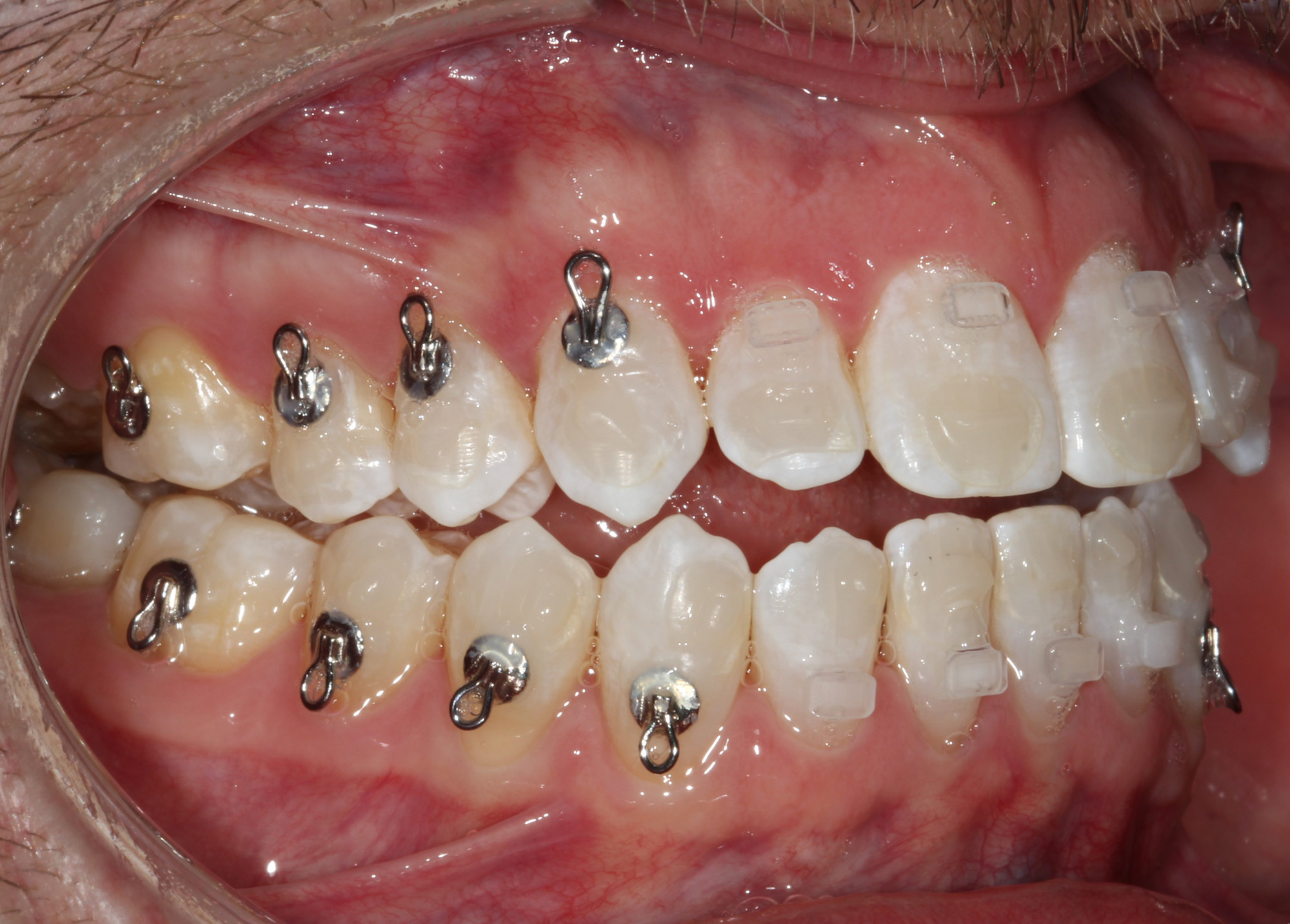 Side view of the bite during pre-surgical orthodontics before open bite jaw surgery, Dr. Vanderstelt in Denver