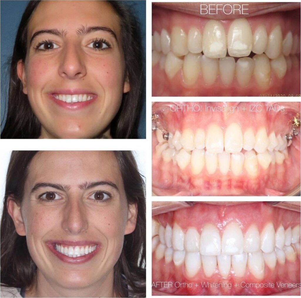 Adult patient before and after Invisalign with TADs, then whitening and composite veneers